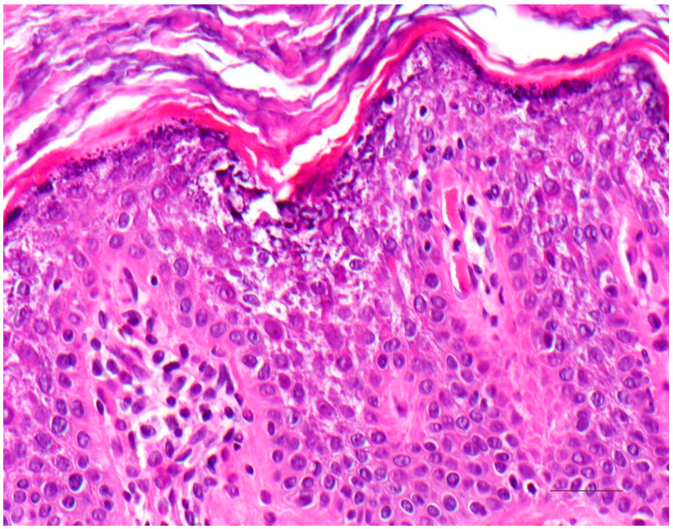 lamellar ichthyosis histology