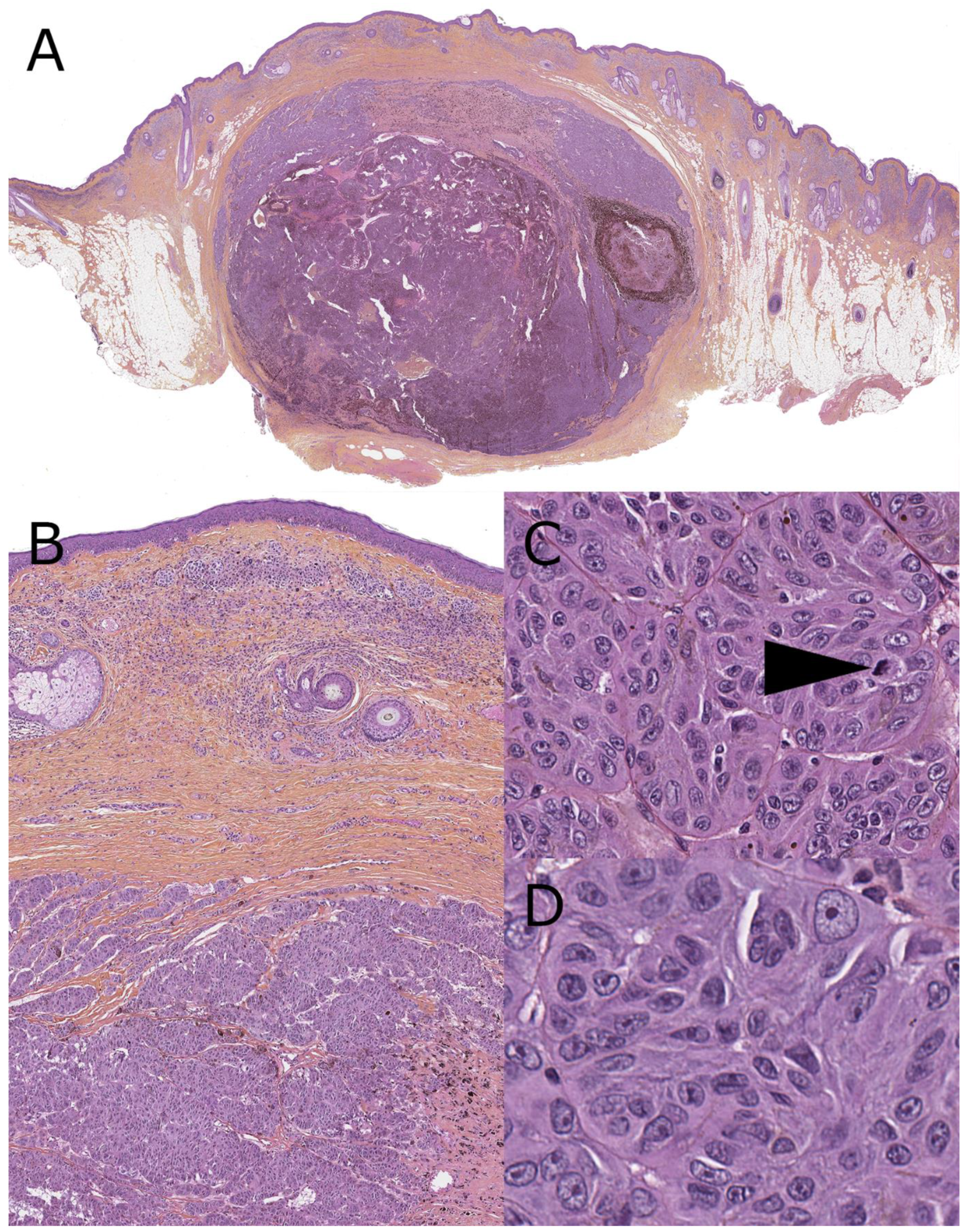 congenital melanocytic nevus histology
