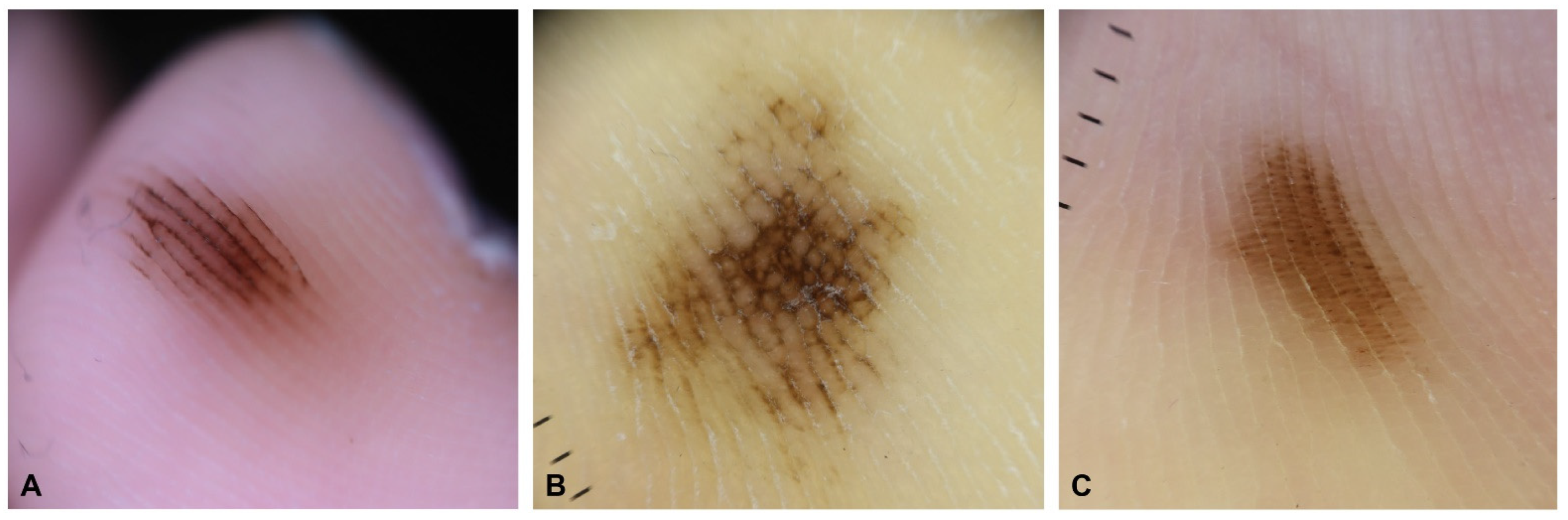 Surgical & Cosmetic Dermatology  Role of Dermoscopy in Distinguishing Tinea  Nigra from Acral Nevus