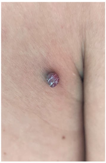 Dermatopathology | Free Full-Text | Cutaneous Epithelioid Angiomatous Nodule:  Report of a New Case and Literature Review