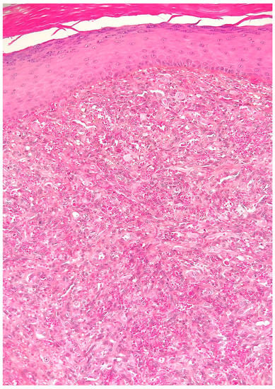 Cutaneous Epithelioid Angiomatous Nodule: Report of a New Case and ...