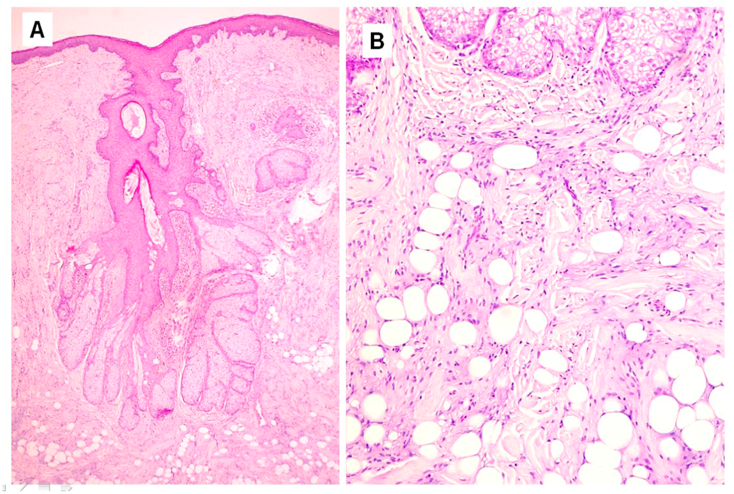 High-power view of fibrous area with ropey collagen bundles and