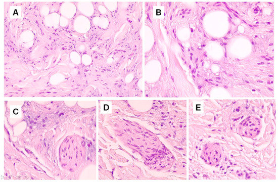 High-power view of fibrous area with ropey collagen bundles and