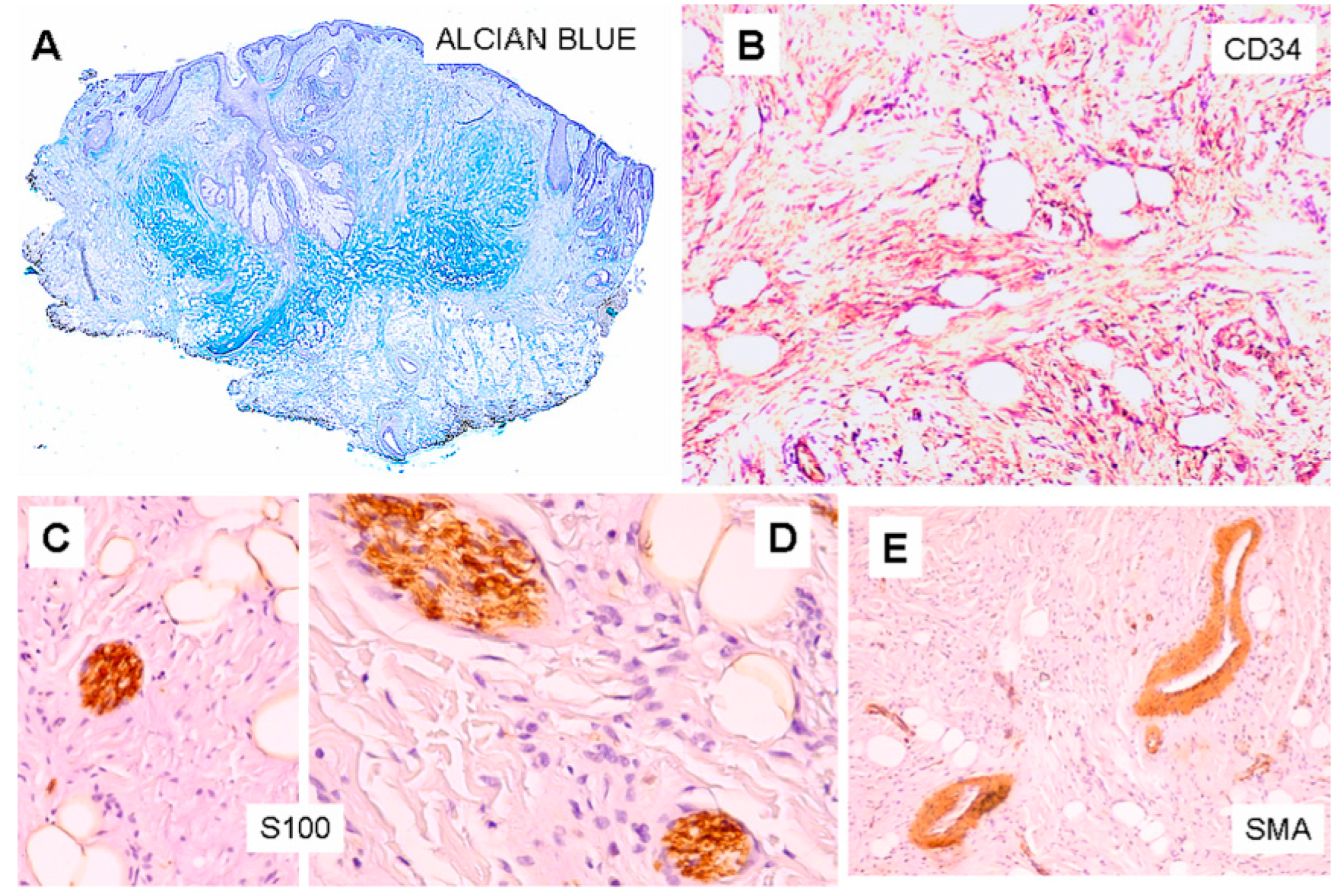 High-power view of fibrous area with ropey collagen bundles and