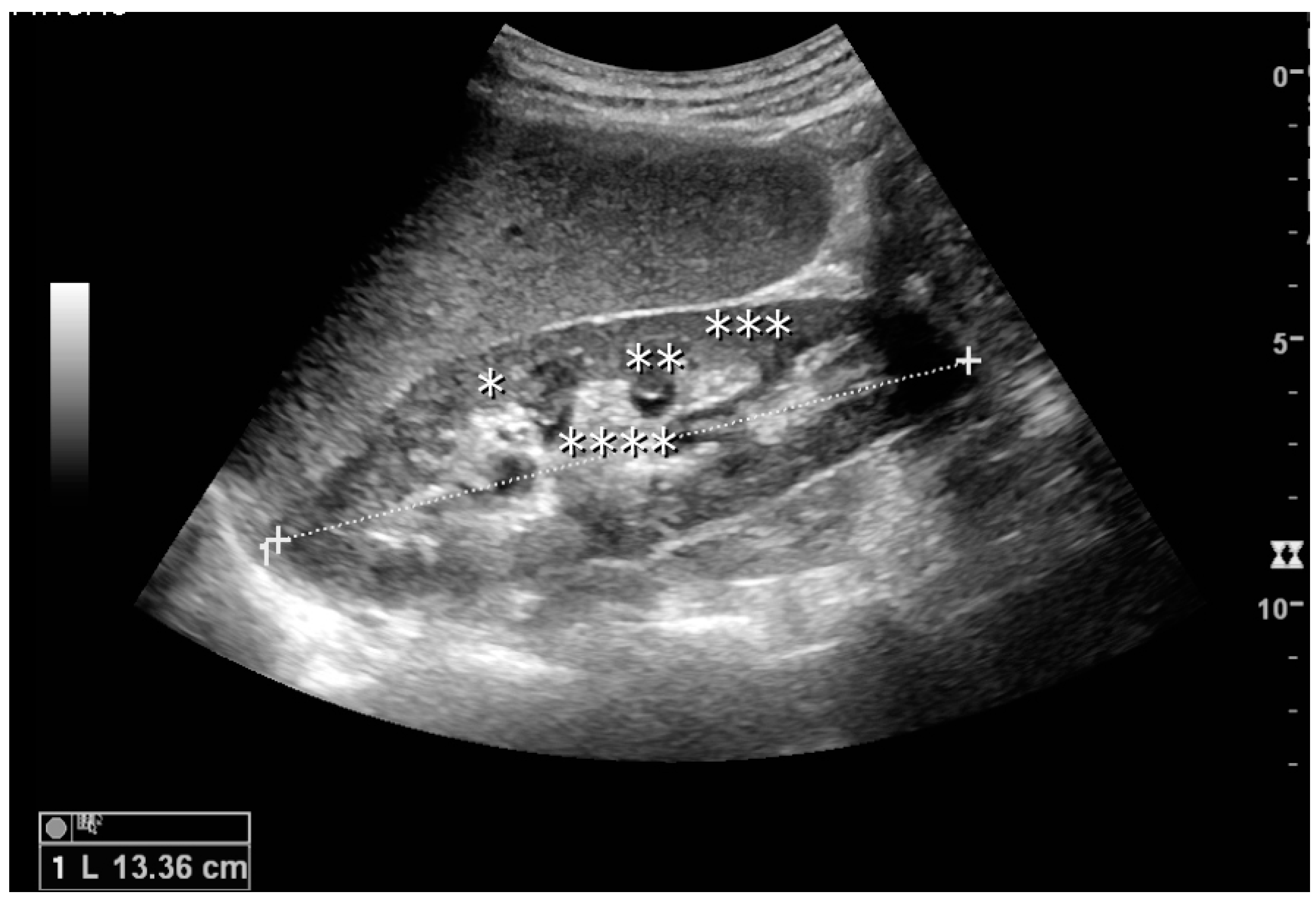 kidney ultrasound images normal