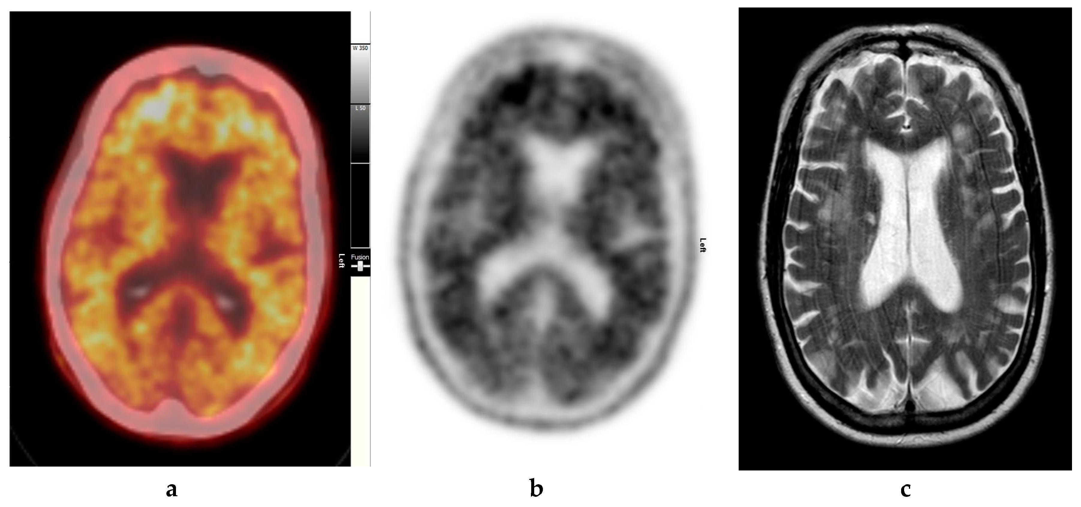 Diagnostics | Free Full-Text | The Who, When, Why, and How of PET Amyloid  Imaging in Management of Alzheimer's Disease—Review of Literature and  Interesting Images | HTML