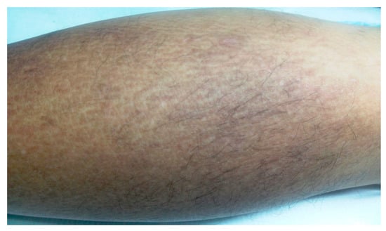 Diagnostics Free Full Text In Vivo Diagnosis Of Primary Cutaneous 9364