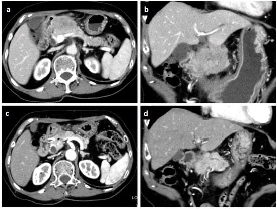 Inflammatory myofibroblastic tumour of an unusual presentation in