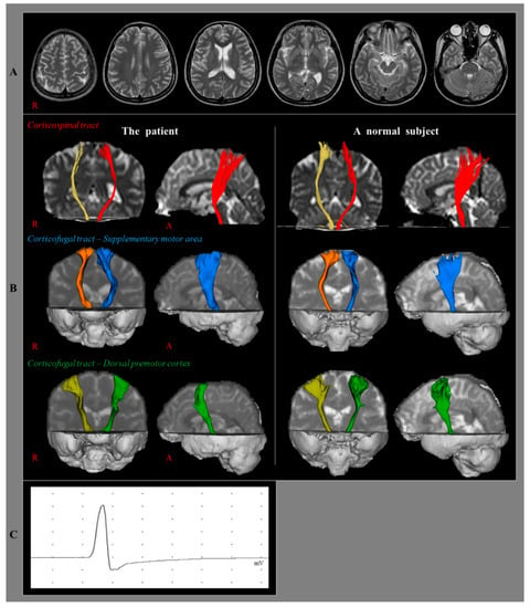 Diagnostics | Free Full-Text | Diagnosis of Conversion Disorder Using  Diffusion Tensor Tractography and Transcranial Magnetic Stimulation in a  Patient with Mild Traumatic Brain Injury | HTML