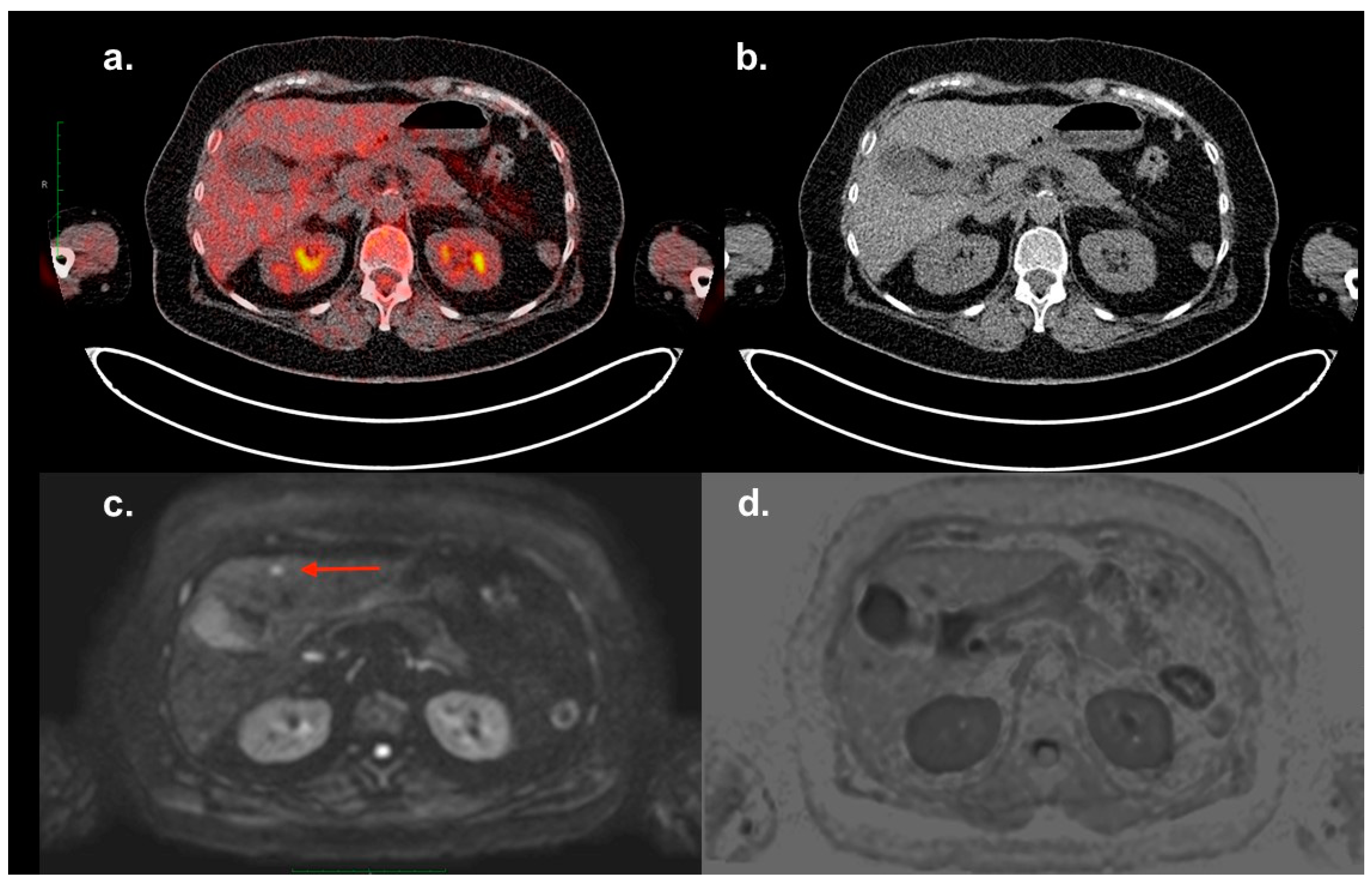 Diagnostics | Free Full-Text | Imaging Features of Multiple Myeloma  Extramedullary Lesions in the Liver with 18F-FDG PET/CT, Contrast-Enhanced  CT and MRI
