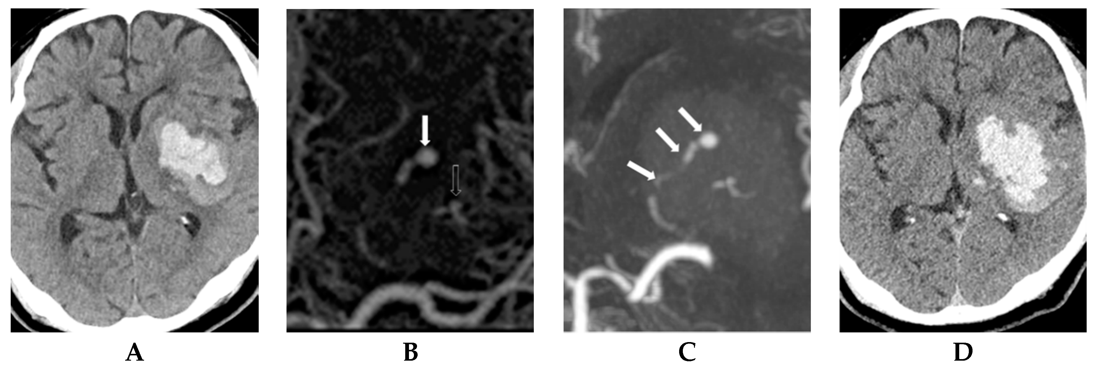 Diagnostics Free Full Text Correlation Between Spot Sign And Intracranial Hemorrhage