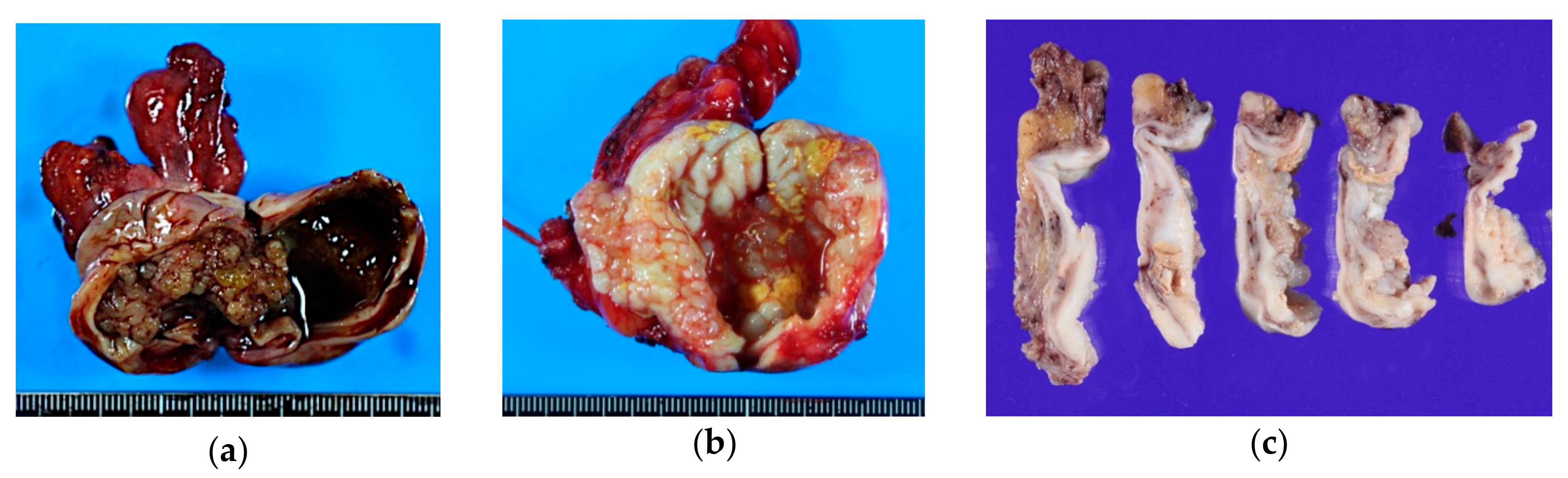 a Picture of an ovarian seromucinous borderline tumour. The