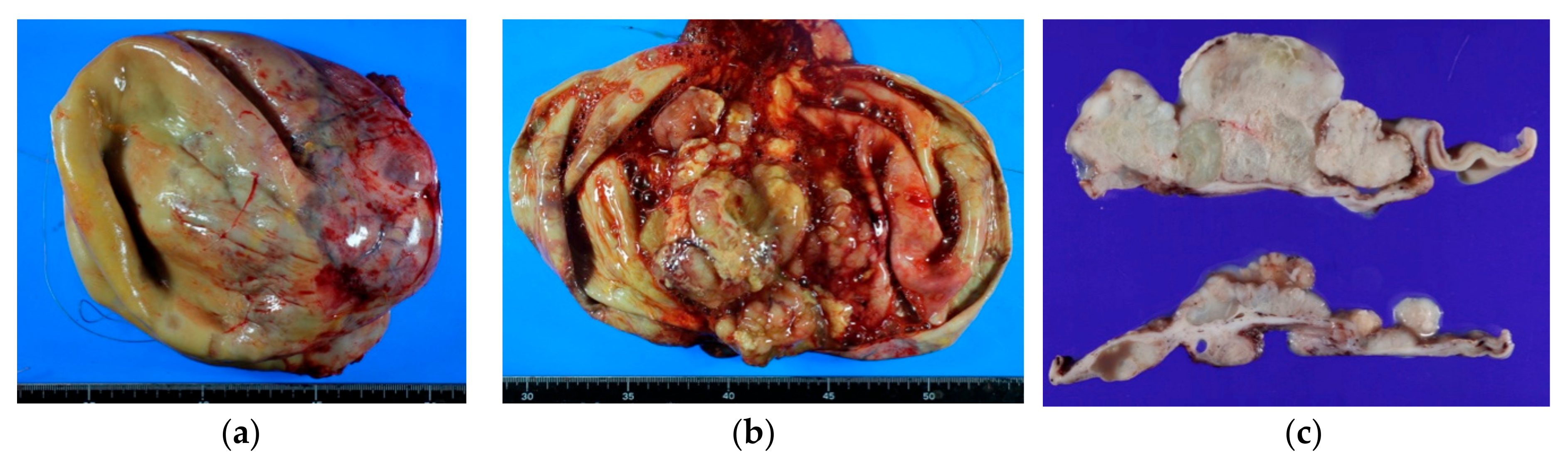 a Picture of an ovarian seromucinous borderline tumour. The