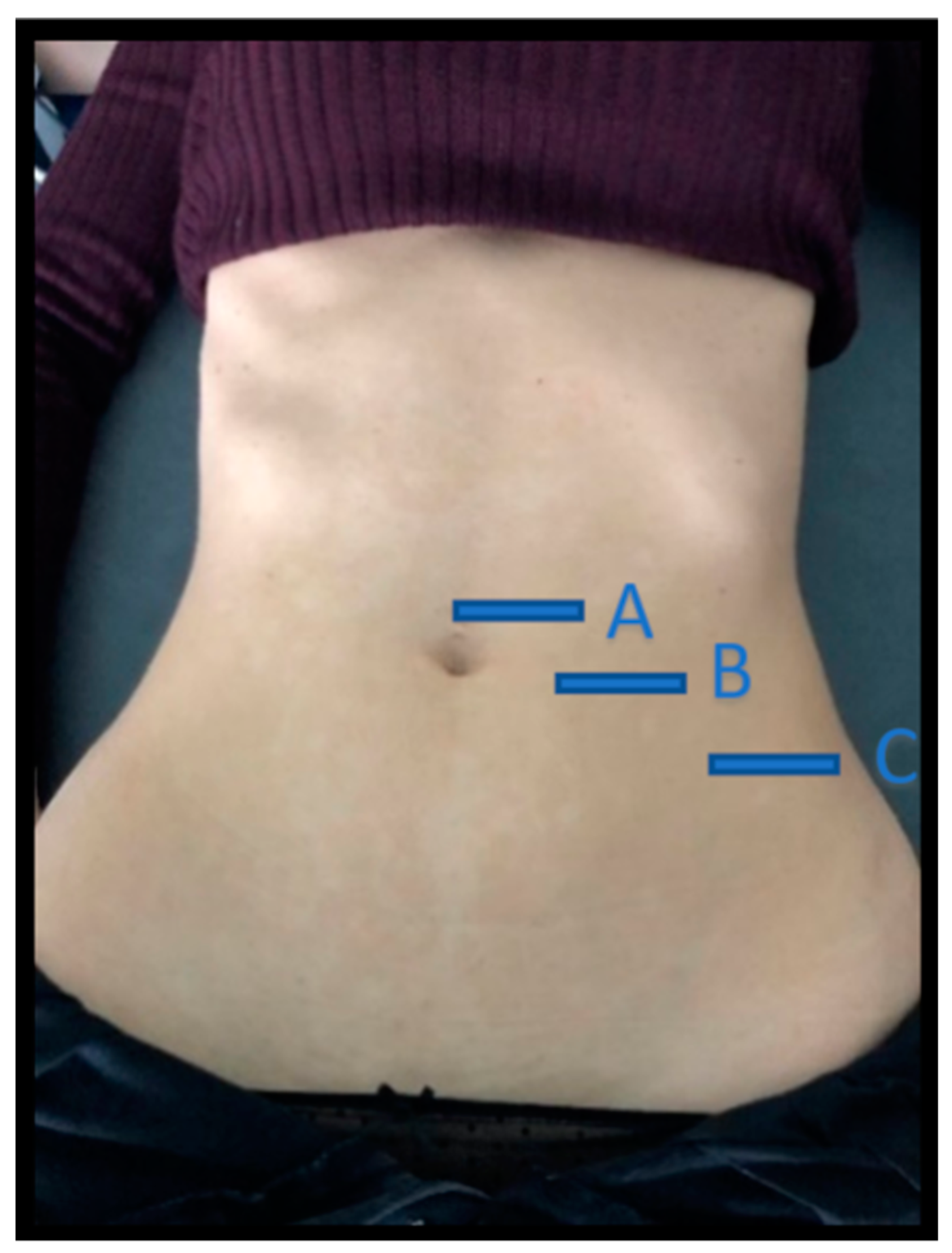 Front view of patient's abdominal taping (rectus abdominus and