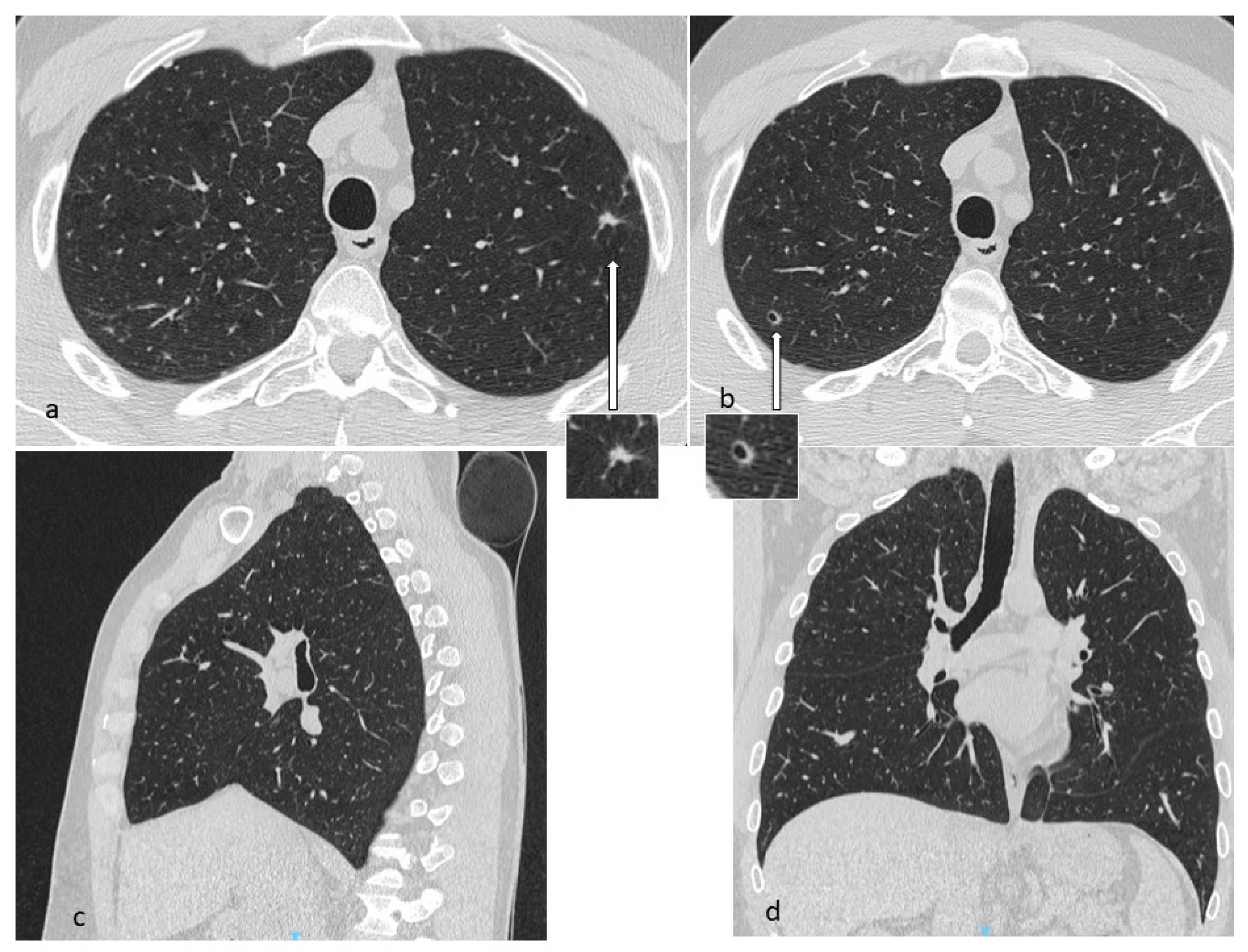 Diagnostics | Free Full-Text | Cystic Interstitial Lung Diseases: A  Pictorial Review and a Practical Guide for the Radiologist