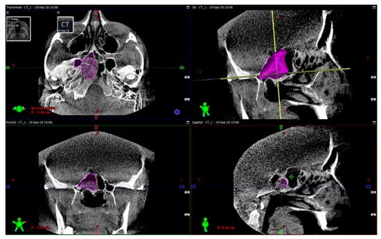 Diagnostics Free Full Text Intraoperative Sphenoid Sinus Volume Measurement As An 3993