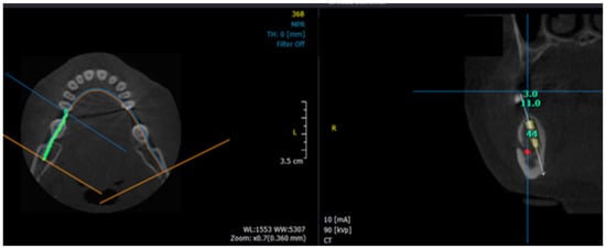 Diagnostics Free Full Text A Cbct Based Three Dimensional Assessment Of Mandibular Posterior