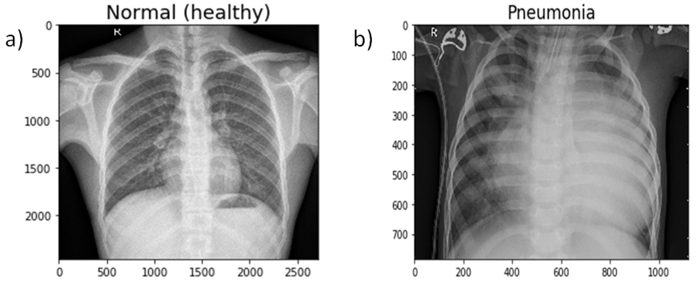Diagnostics | Free Full-Text | Efficient Pneumonia Detection in Chest Xray  Images Using Deep Transfer Learning