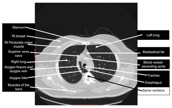 Diagnostics Free Full Text Azygos Lobe Prevalence Of An Anatomical