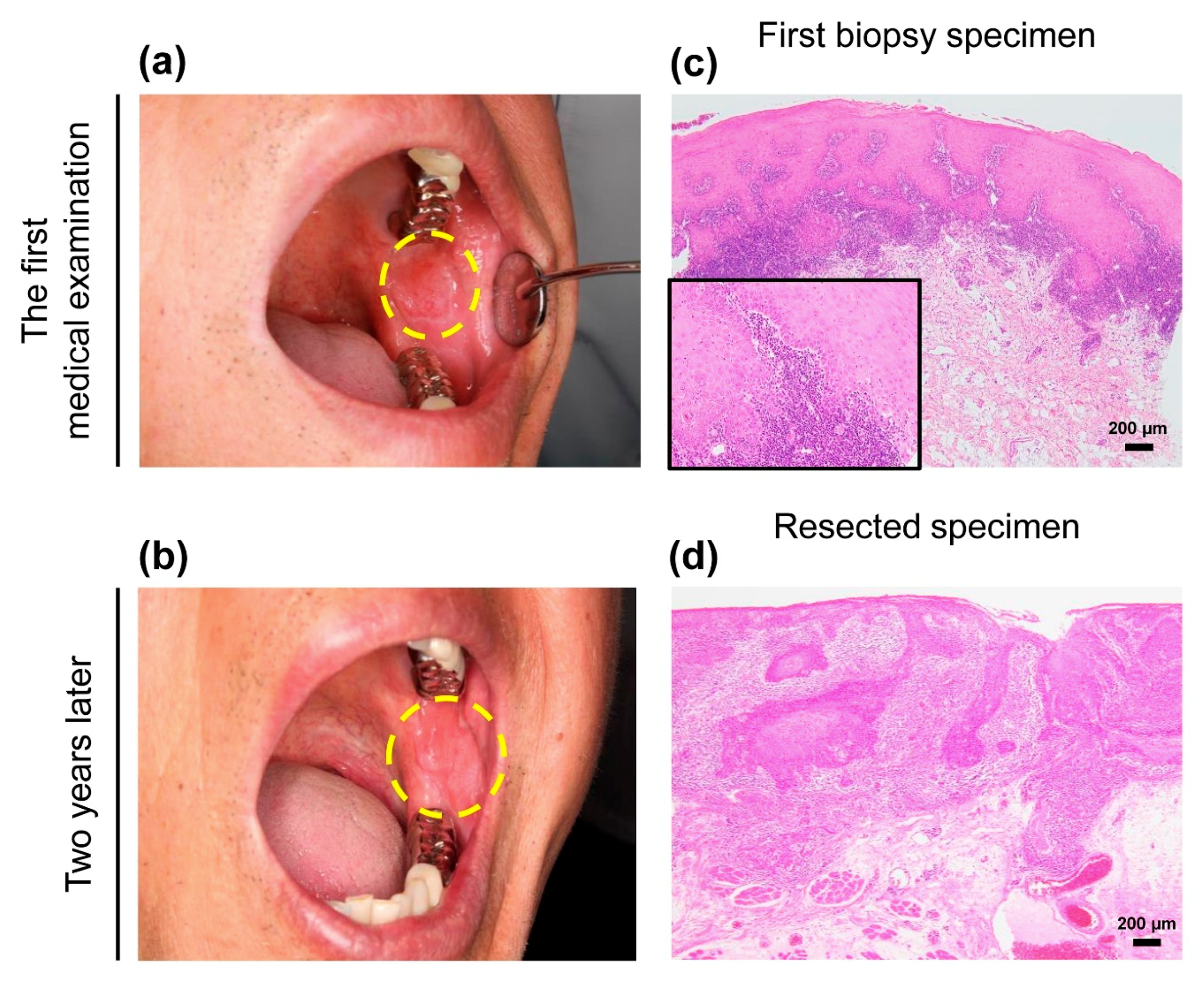 A 7-year retrospective study of biopsied oral lesions in 460