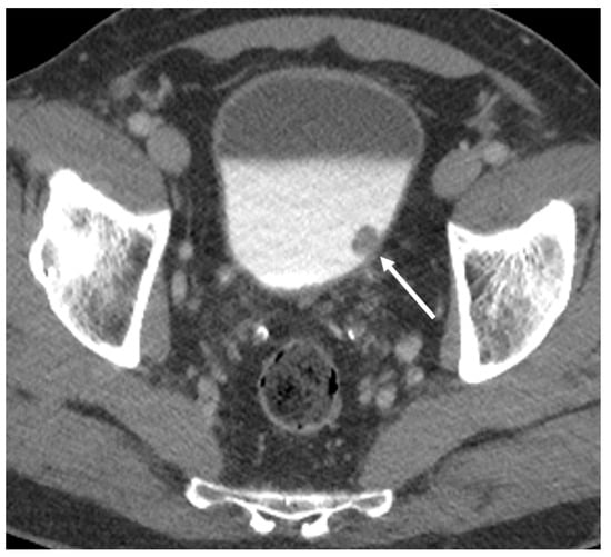 Diagnostics | Free Full-Text | The Role Of Imaging In Bladder Cancer ...