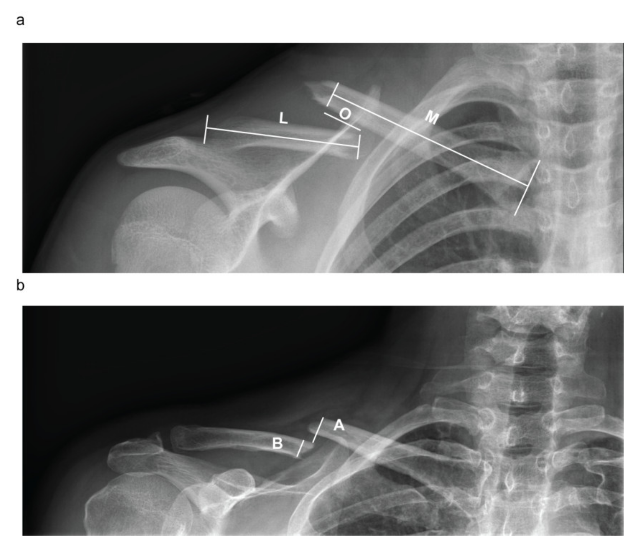 Diagnostics | Free Full-Text | Midshaft Clavicle Fractures Treated  Nonoperatively Using Figure-of-Eight Bandage: Are Fracture Type,  Shortening, and Displacement Radiographic Predictors of Failure?