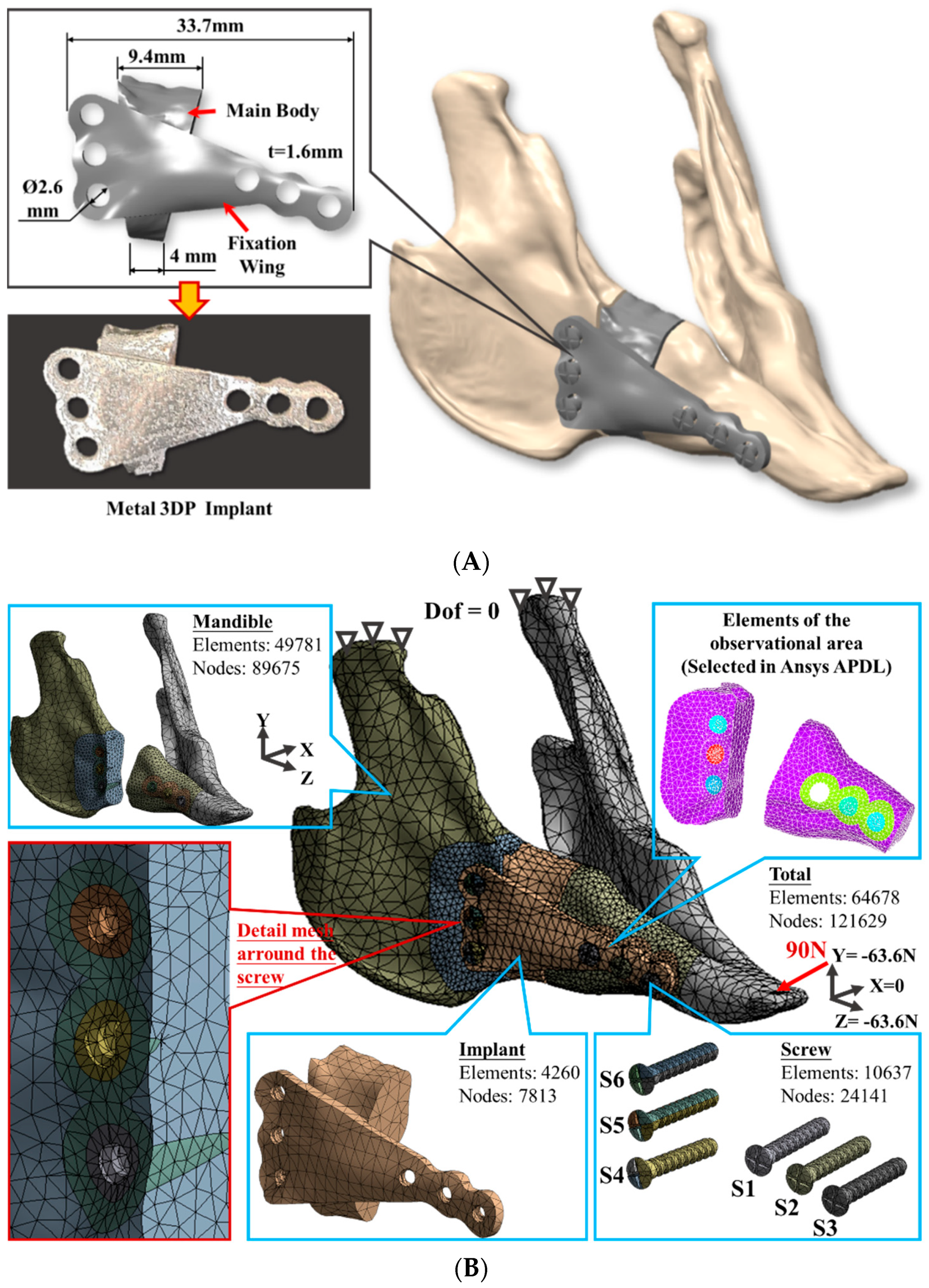 Stability of different fixation methods after reduction malarplasty under  average and maximum masticatory forces: a finite element analysis, BioMedical Engineering OnLine