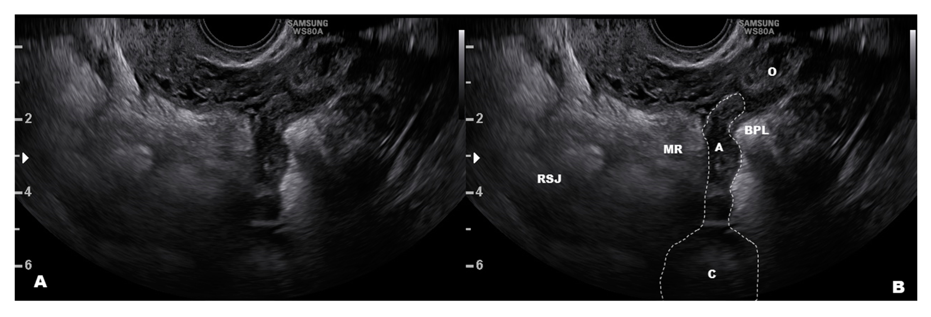Diagnostics Free Full Text Differential Diagnosis Of Endometriosis By Ultrasound A Rising Challenge Html