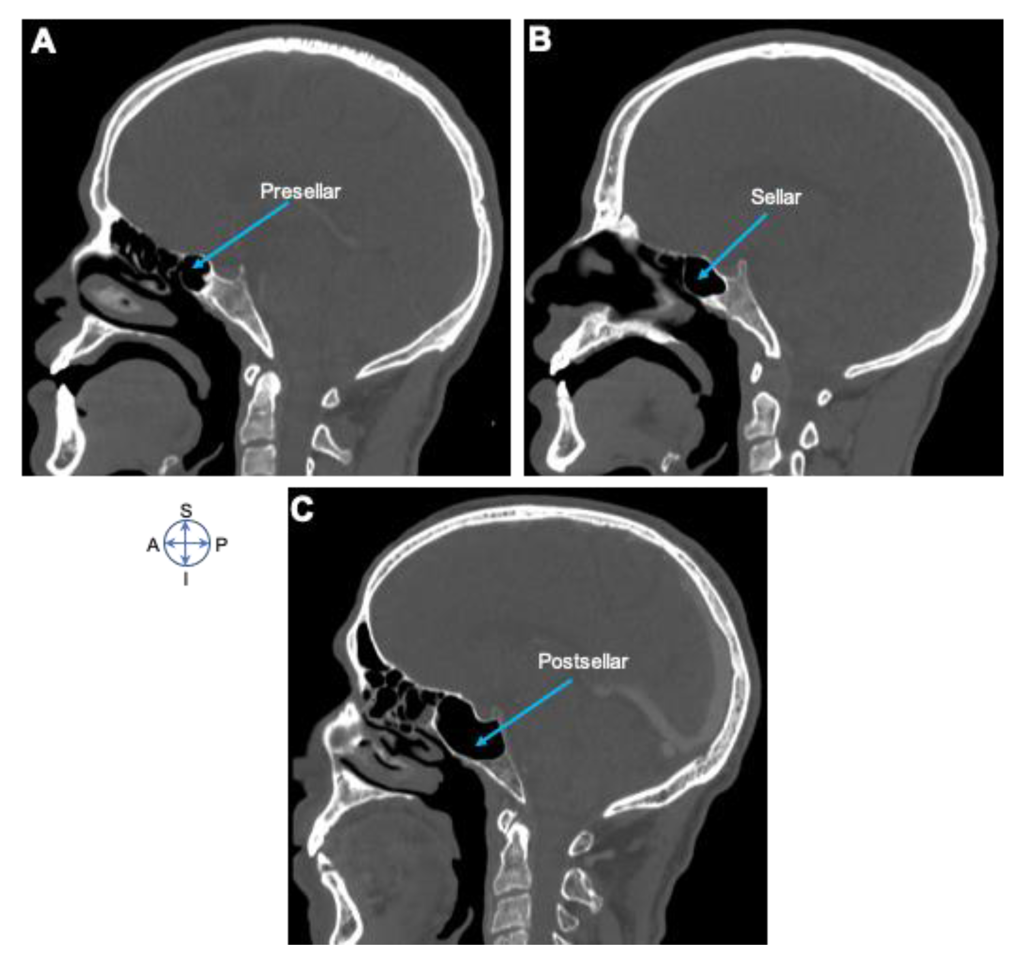 Sphenoid Sinus Pneumatization Types Radiology