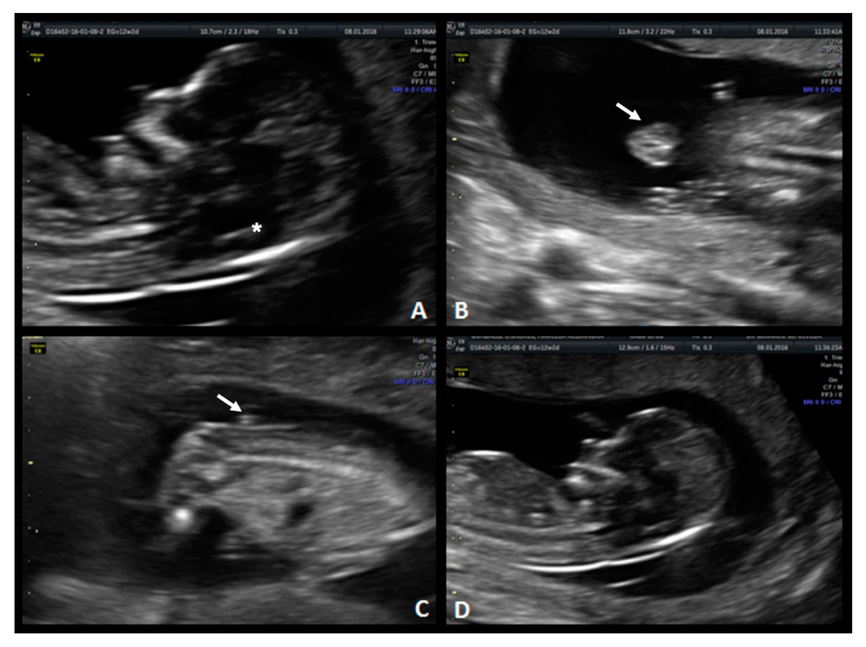 spina bifida ultrasound 12 weeks