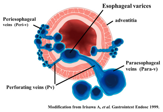 Diagnostics | Free Full-Text | The Role of Endoscopic Ultrasound for  Esophageal Varices | HTML