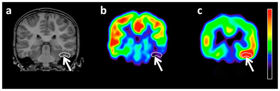 Diagnostics | Free Full-Text | Molecular Imaging of Brain Tumor 
