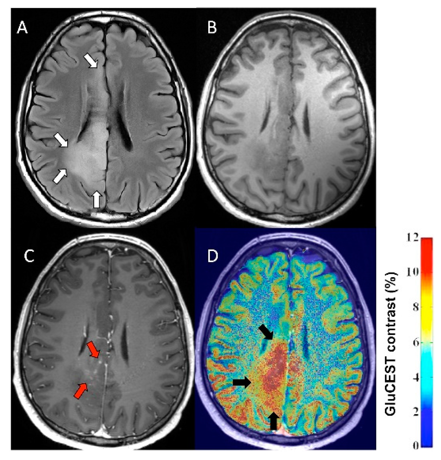 Epilepsy Brain Mri 8378