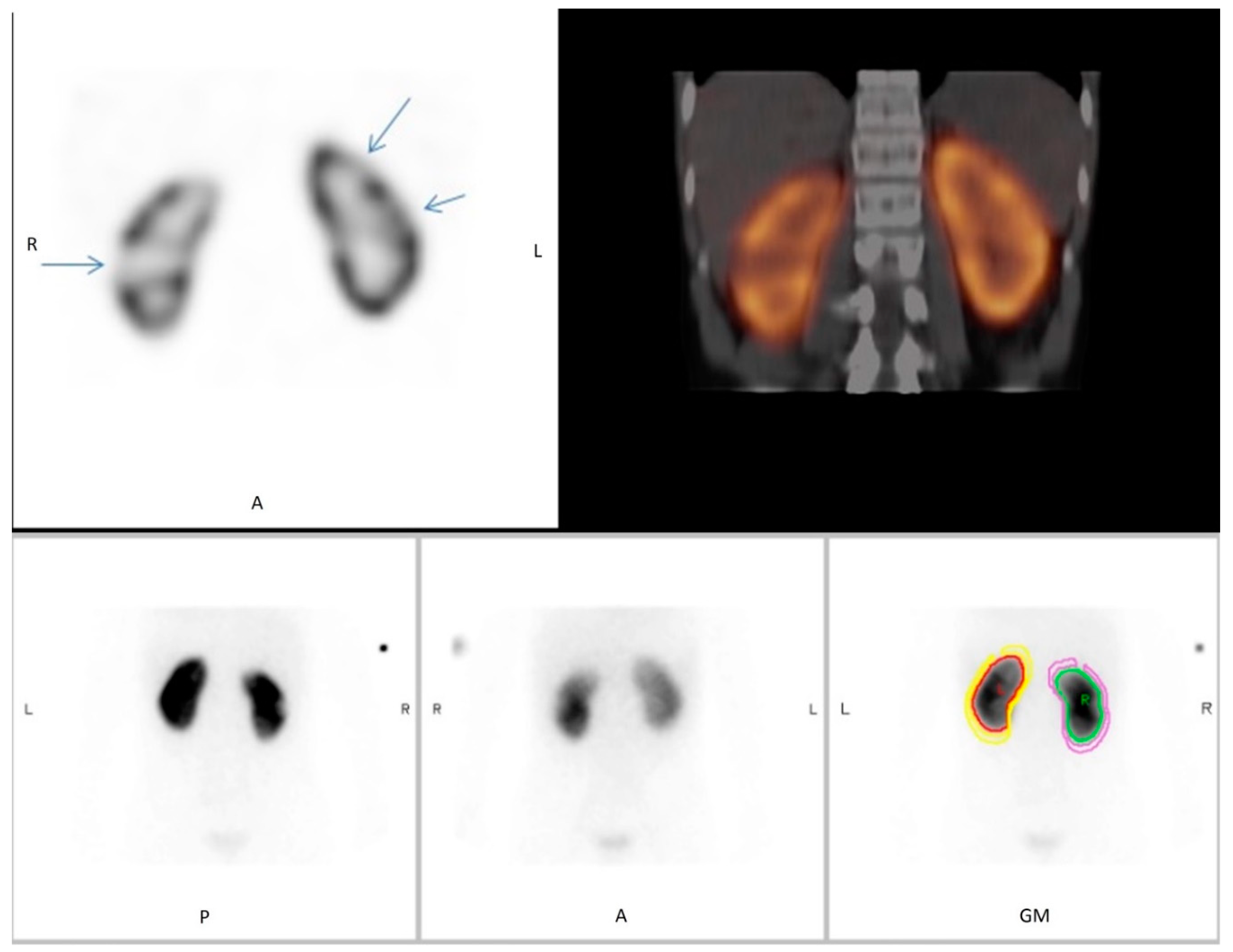 Diagnostics | Free Full-Text | Interrater Reliability of 99mTc-DMSA  Scintigraphy Performed as Planar Scan vs. SPECT/Low Dose CT for Diagnosing  Renal Scarring in Children | HTML