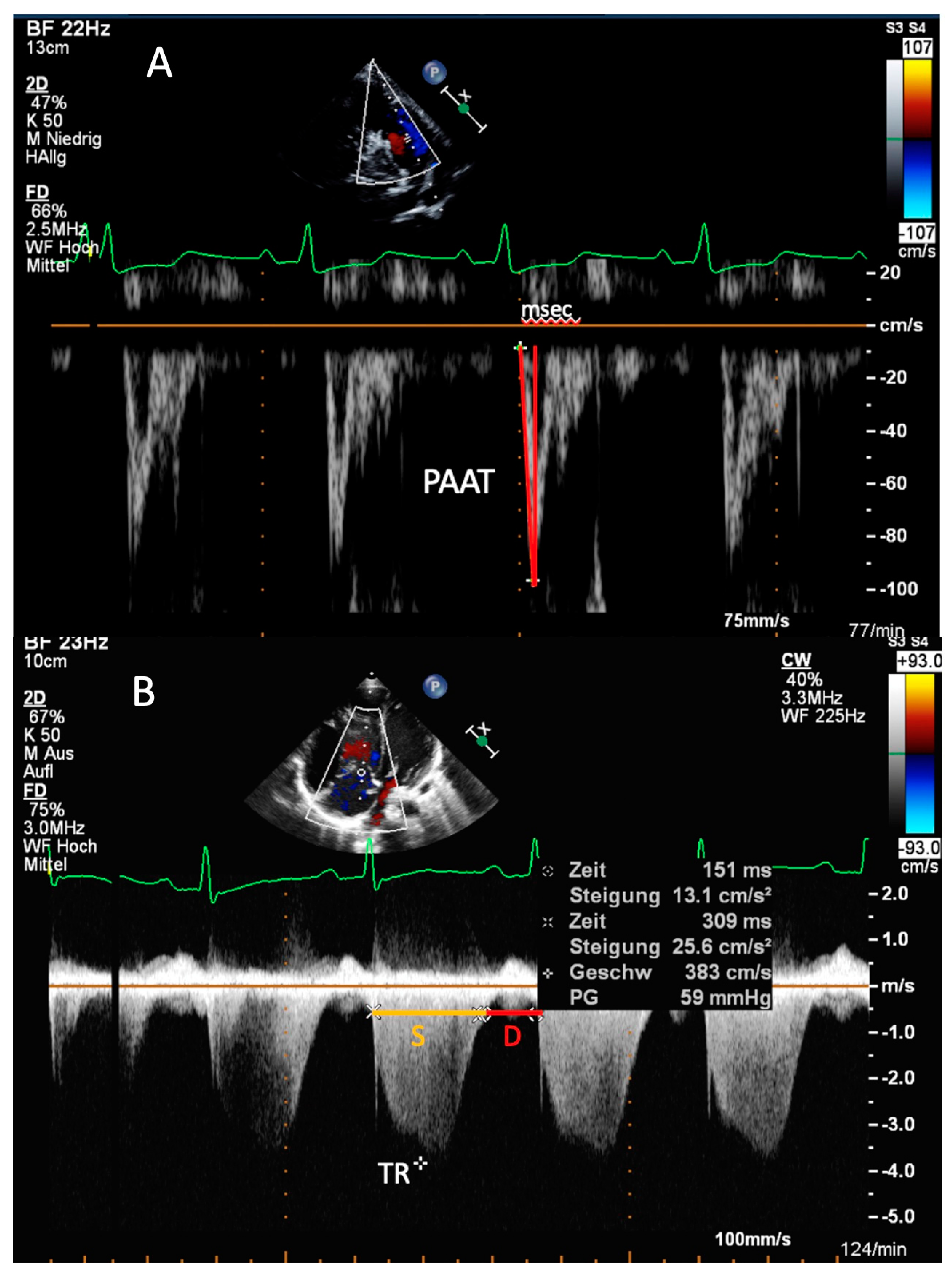 Diagnostics | Free Full-Text | Echocardiography for the Assessment of  Pulmonary Hypertension and Congenital Heart Disease in the Young