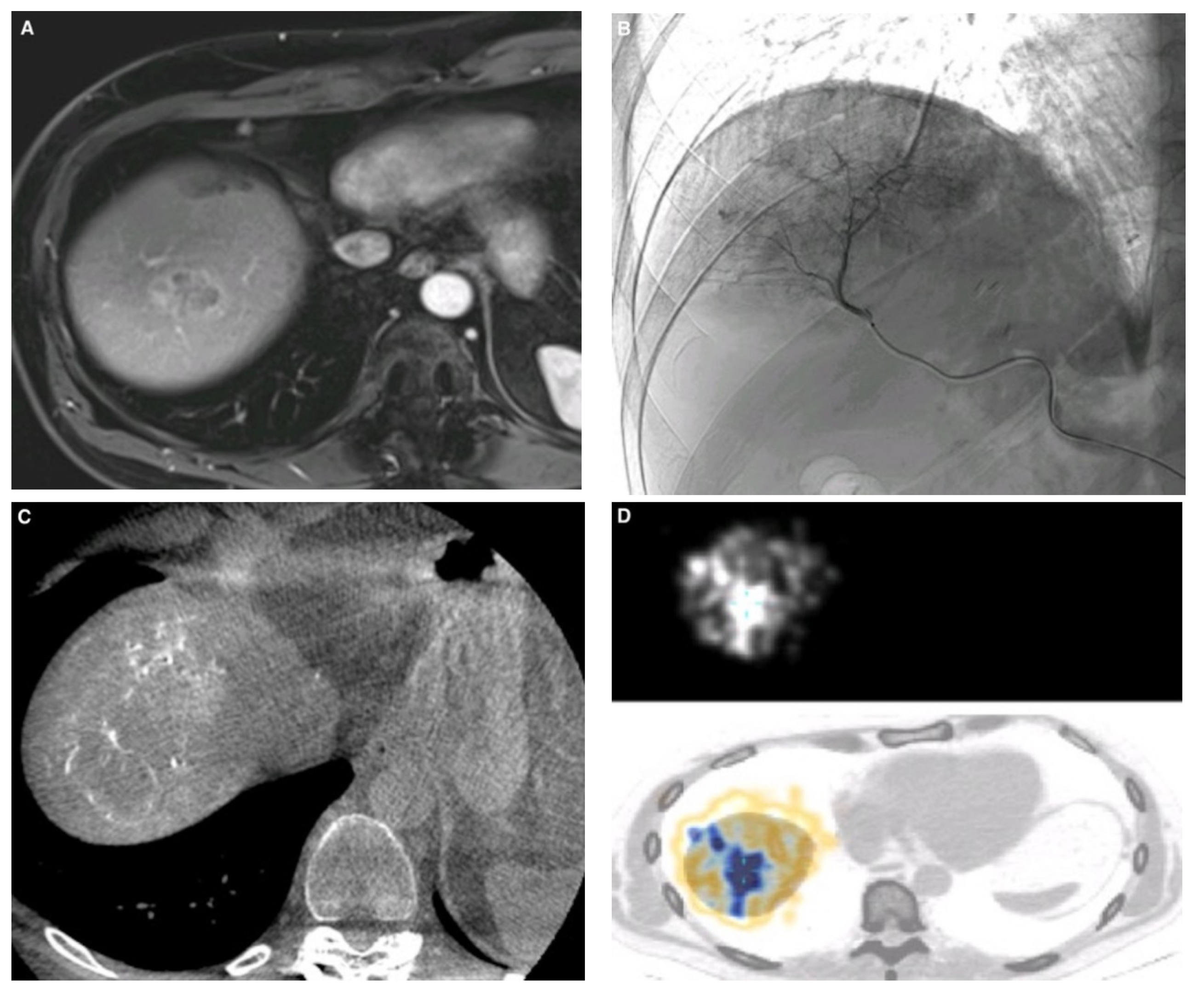Diagnostics | Free Full-Text | Transarterial Radioembolization of  Hepatocellular Carcinoma, Liver-Dominant Hepatic Colorectal Cancer  Metastases, and Cholangiocarcinoma Using Yttrium90 Microspheres: Eight-Year  Single-Center Real-Life Experience | HTML
