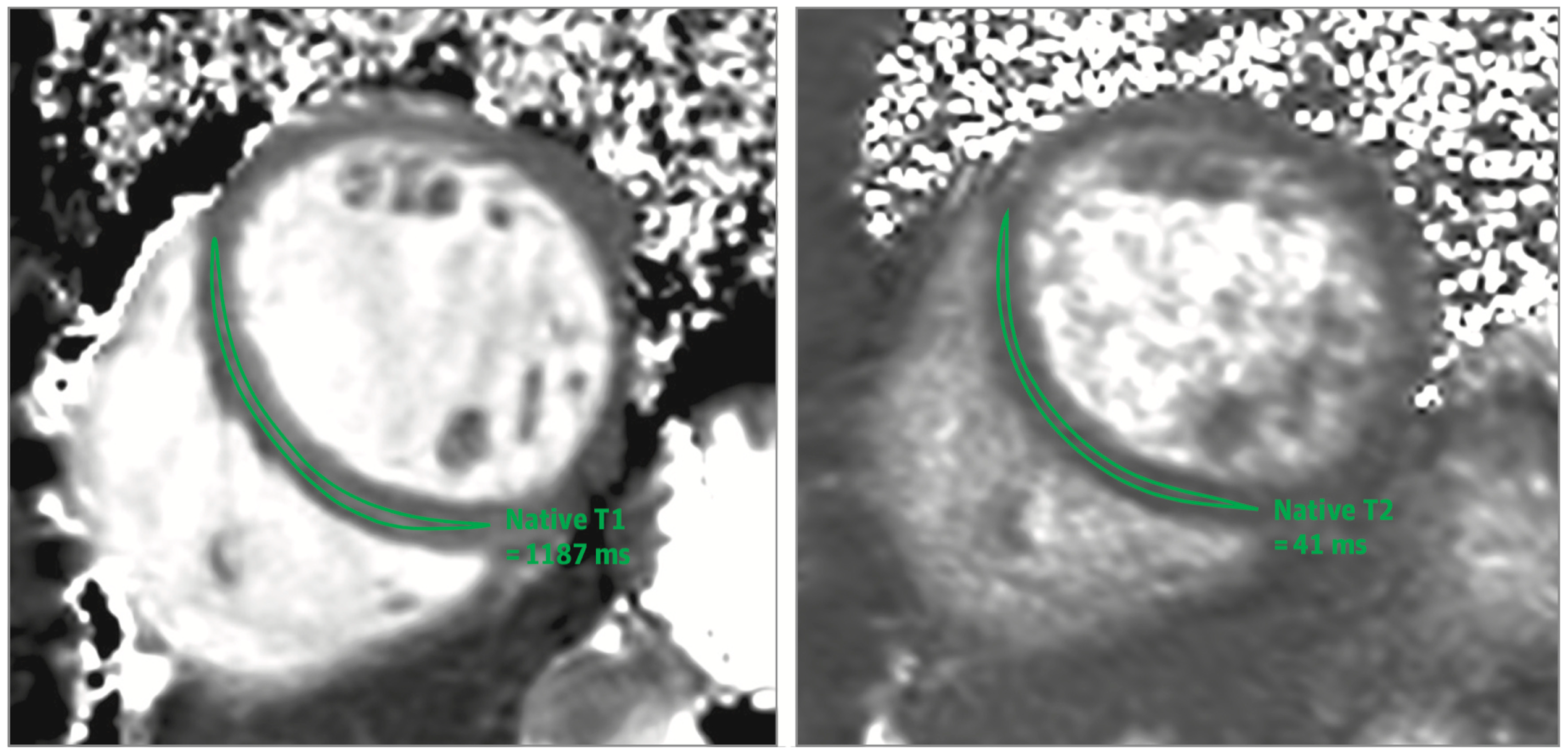 T2 Relaxation Times at Cardiac MRI in Healthy Adults: A Systematic