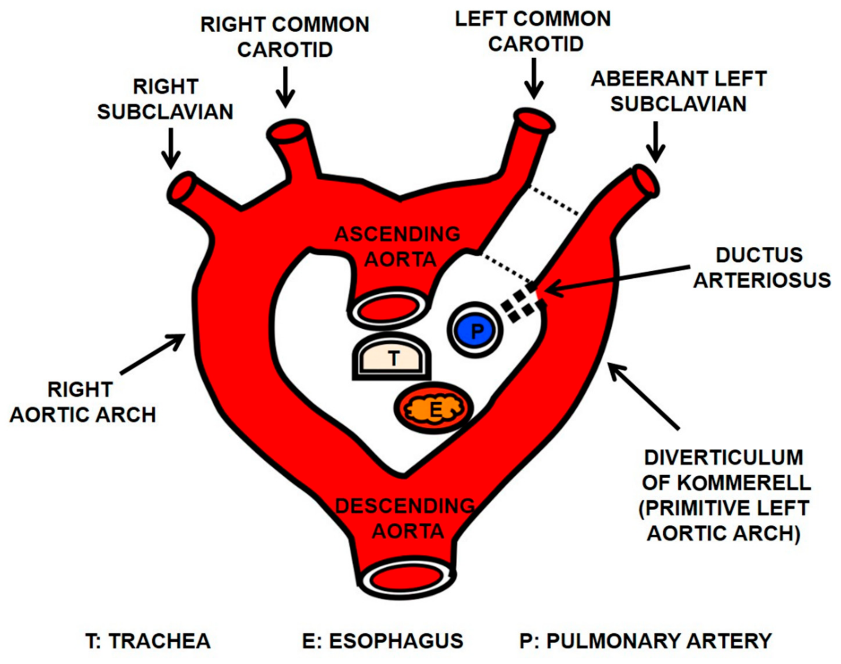 left subclavian artery