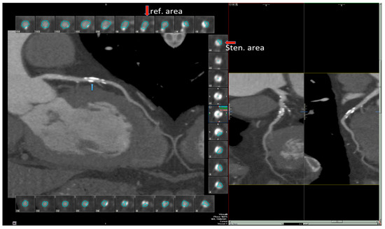 Diagnostics Free Full Text Coronary Flow And Reserve By Enhanced Transthoracic Doppler Trumps Coronary Anatomy By Computed Tomography In Assessing Coronary Artery Stenosis Html