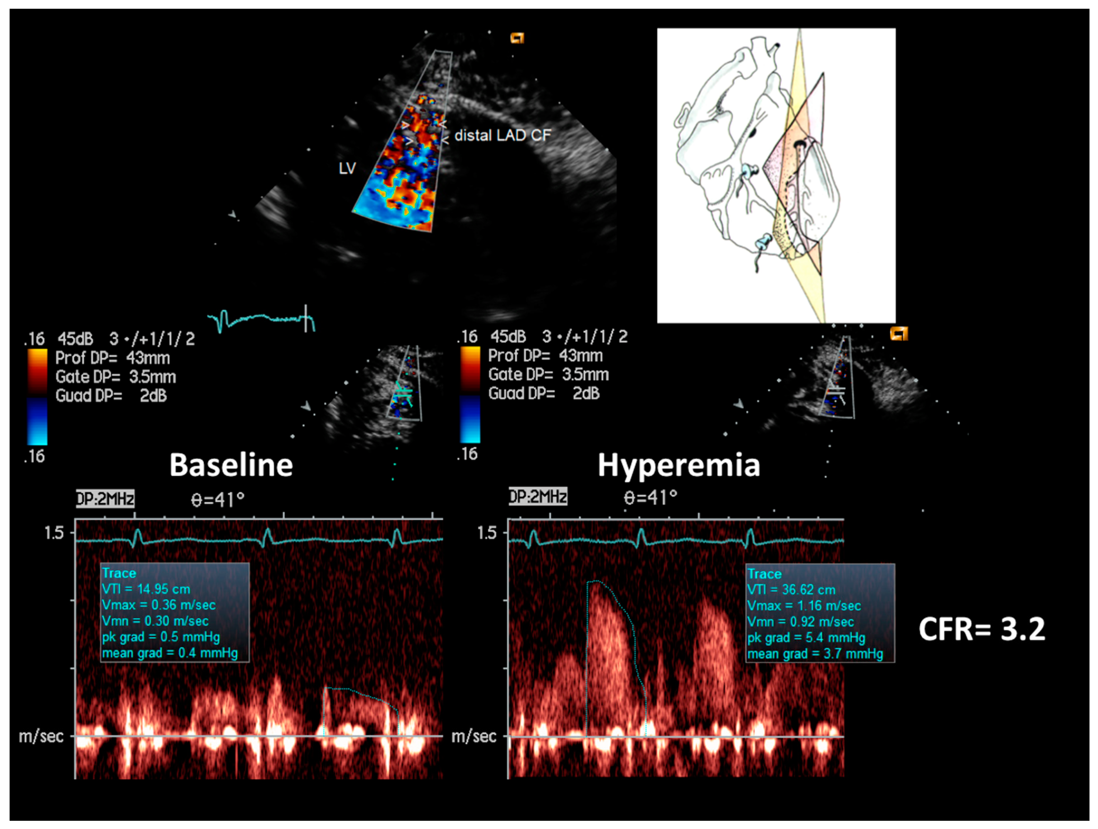 Diagnostics Free Full Text Coronary Flow And Reserve By Enhanced Transthoracic Doppler Trumps Coronary Anatomy By Computed Tomography In Assessing Coronary Artery Stenosis Html