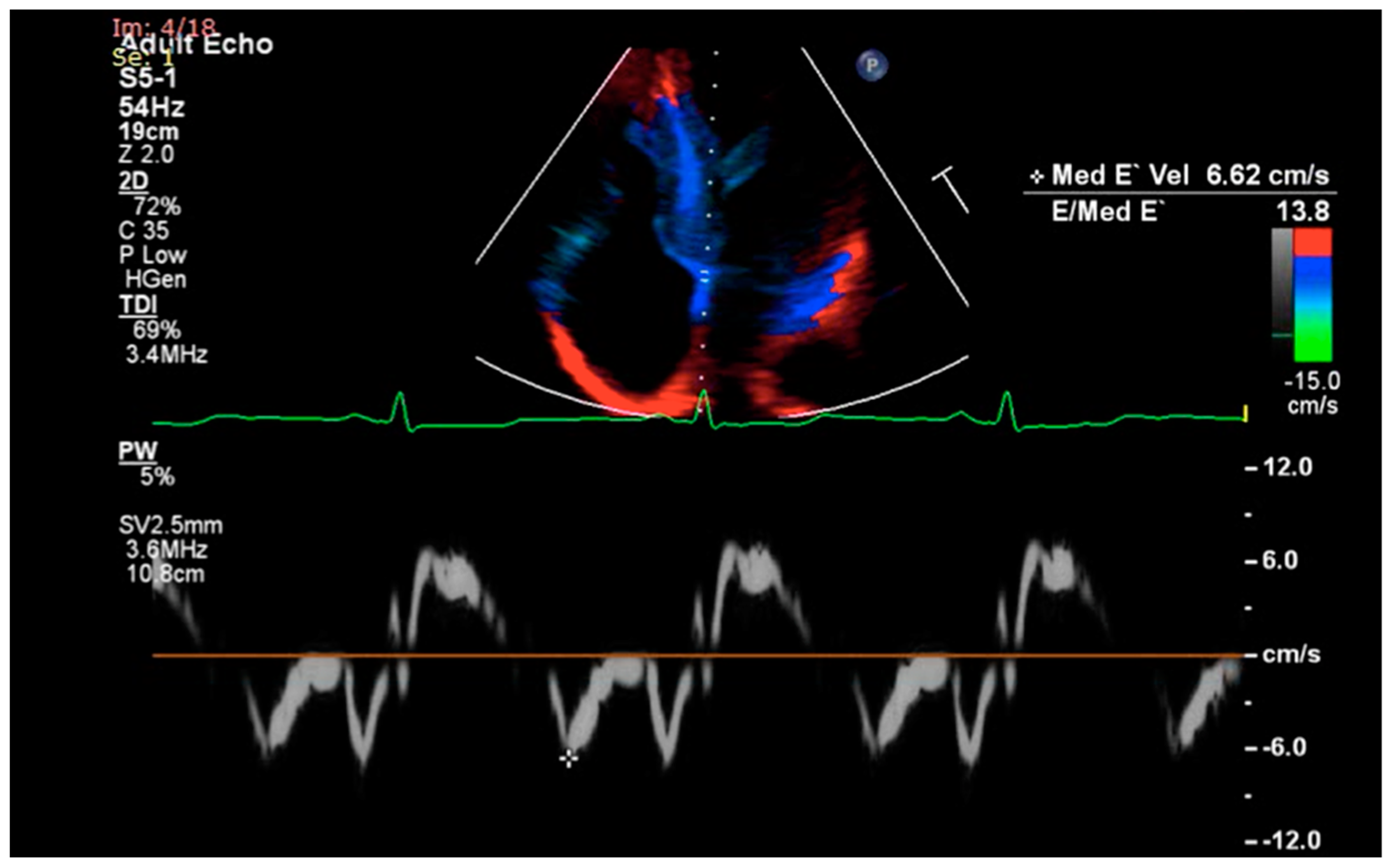 2D/3D strain analysis in a patient with cardiac amyloidosis. Upper