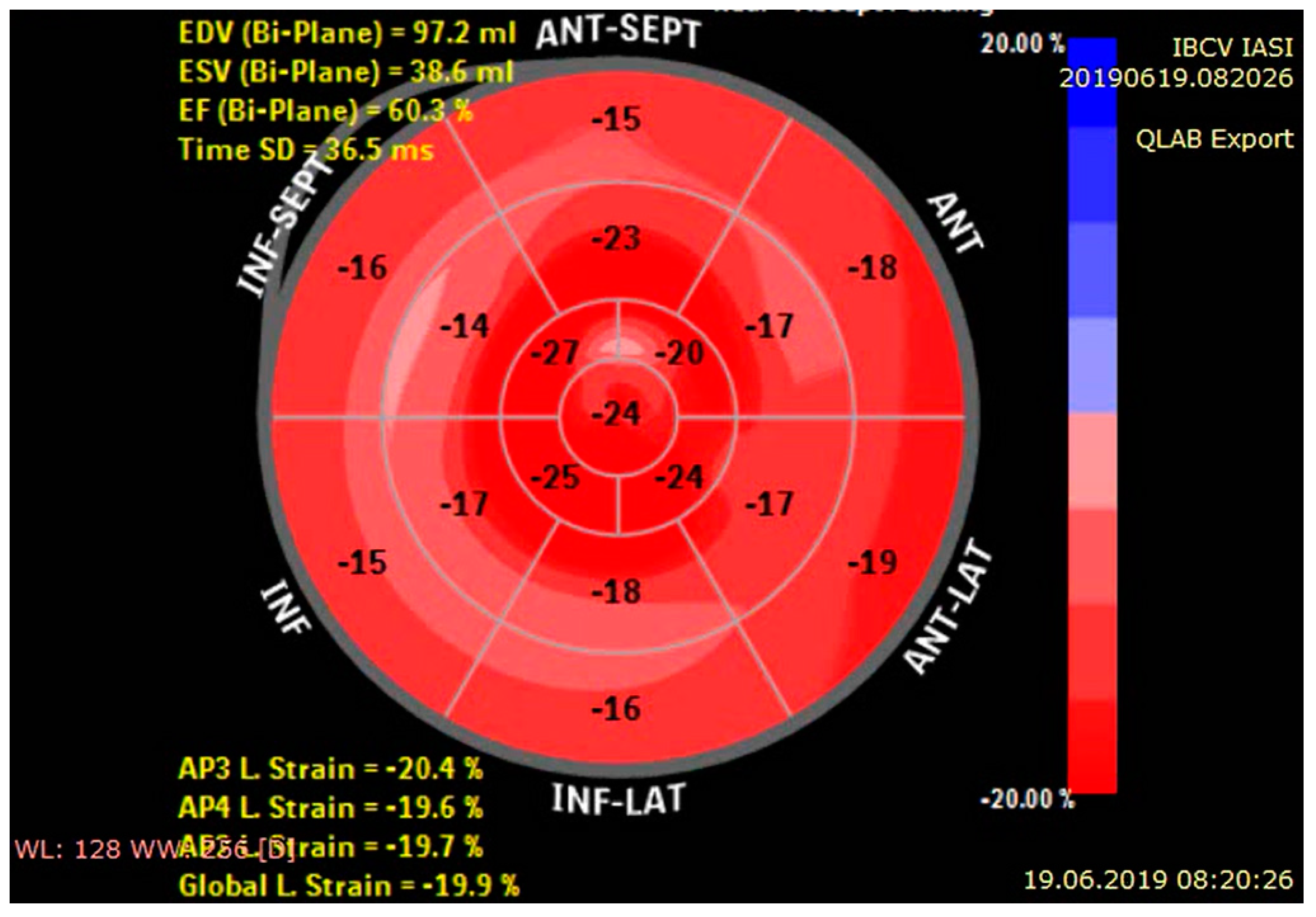Longitudinal strain bull's eye plot patterns in patients with  cardiomyopathy and concentric left ventricular hypertrophy, European  Journal of Medical Research