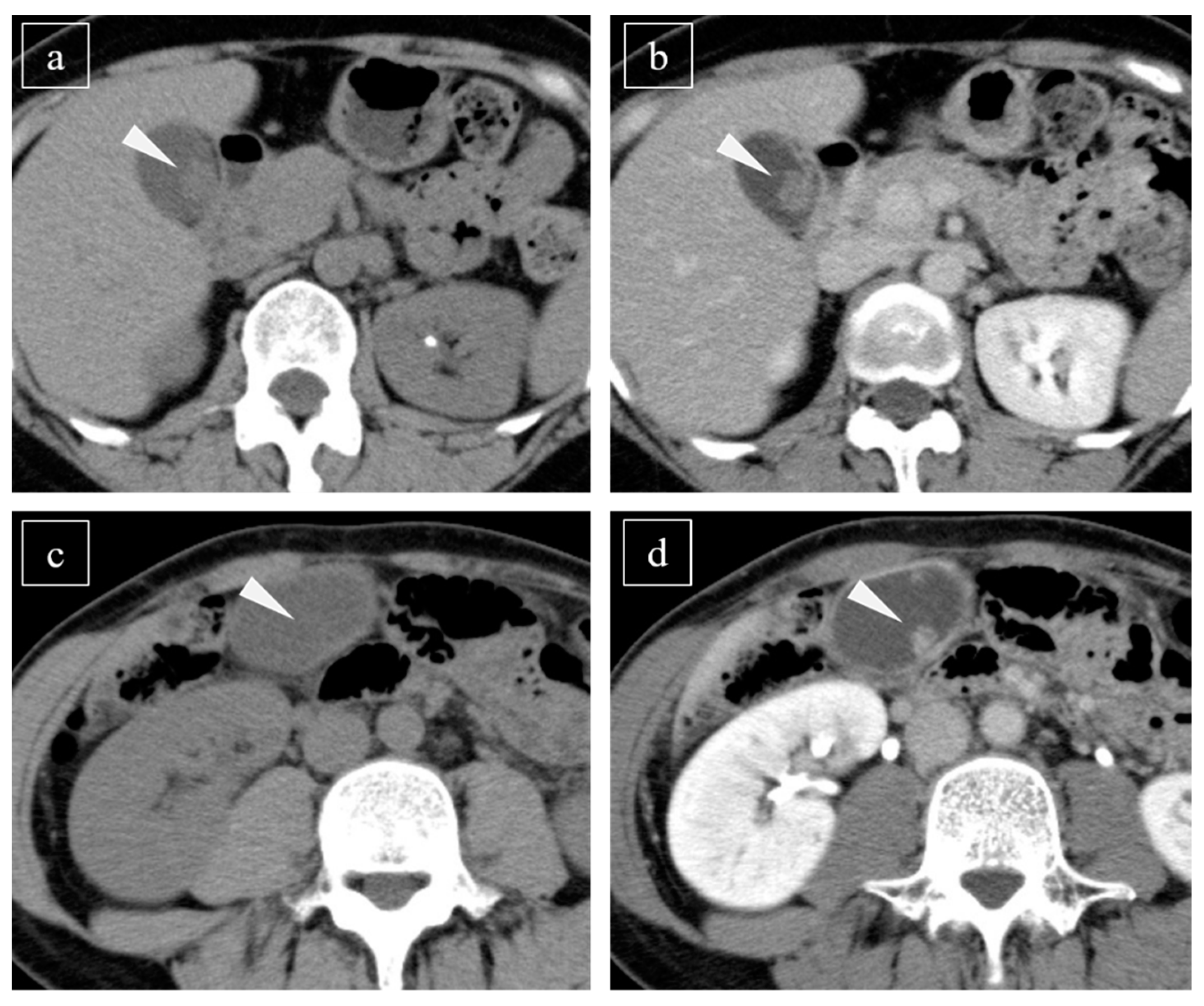 Diagnostics Free Full Text Detectability On Plain Ct Is An