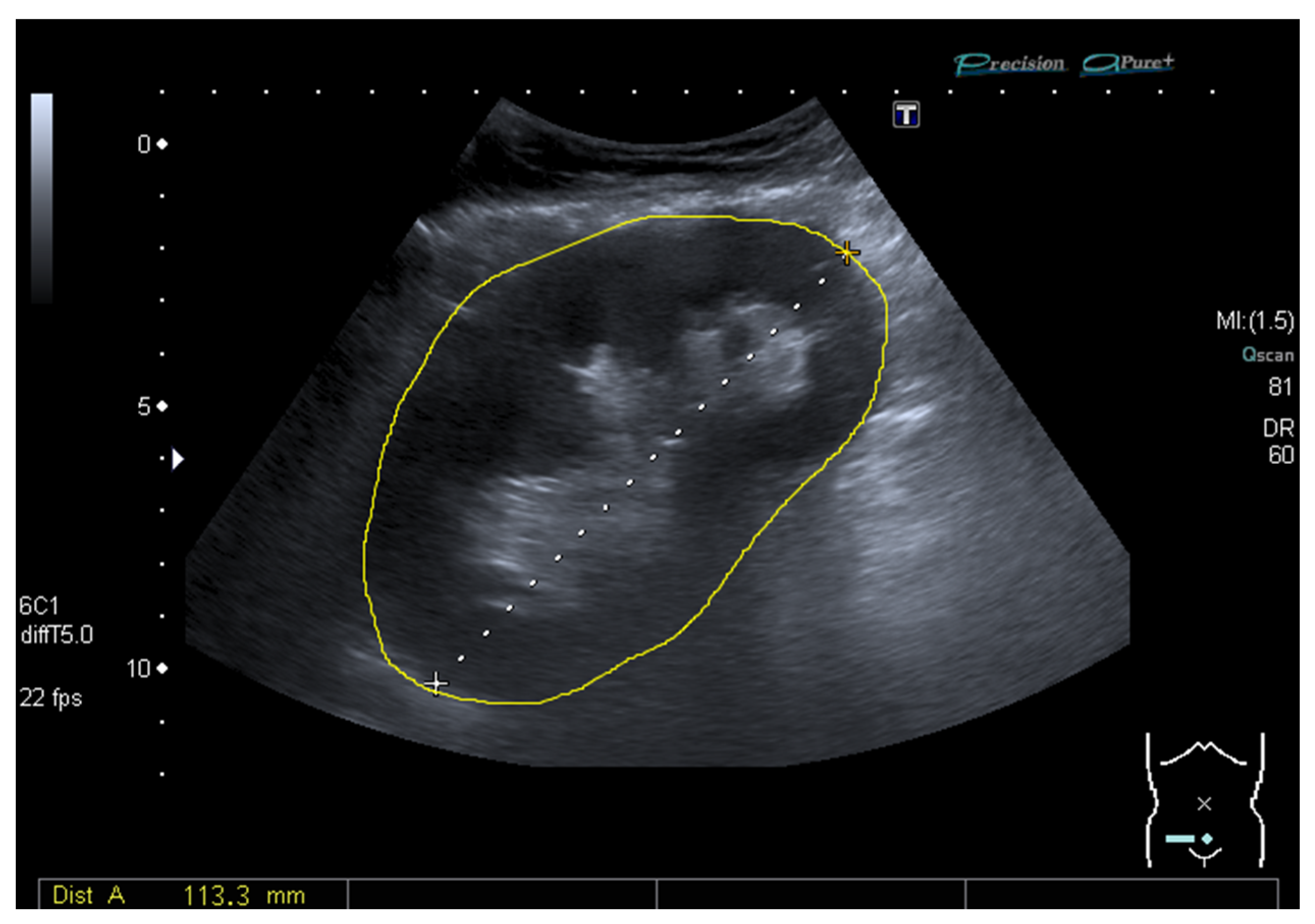 Diagnostics | Free Full-Text | Introduction of the Grayscale Median for  Ultrasound Tissue Characterization of the Transplanted Kidney