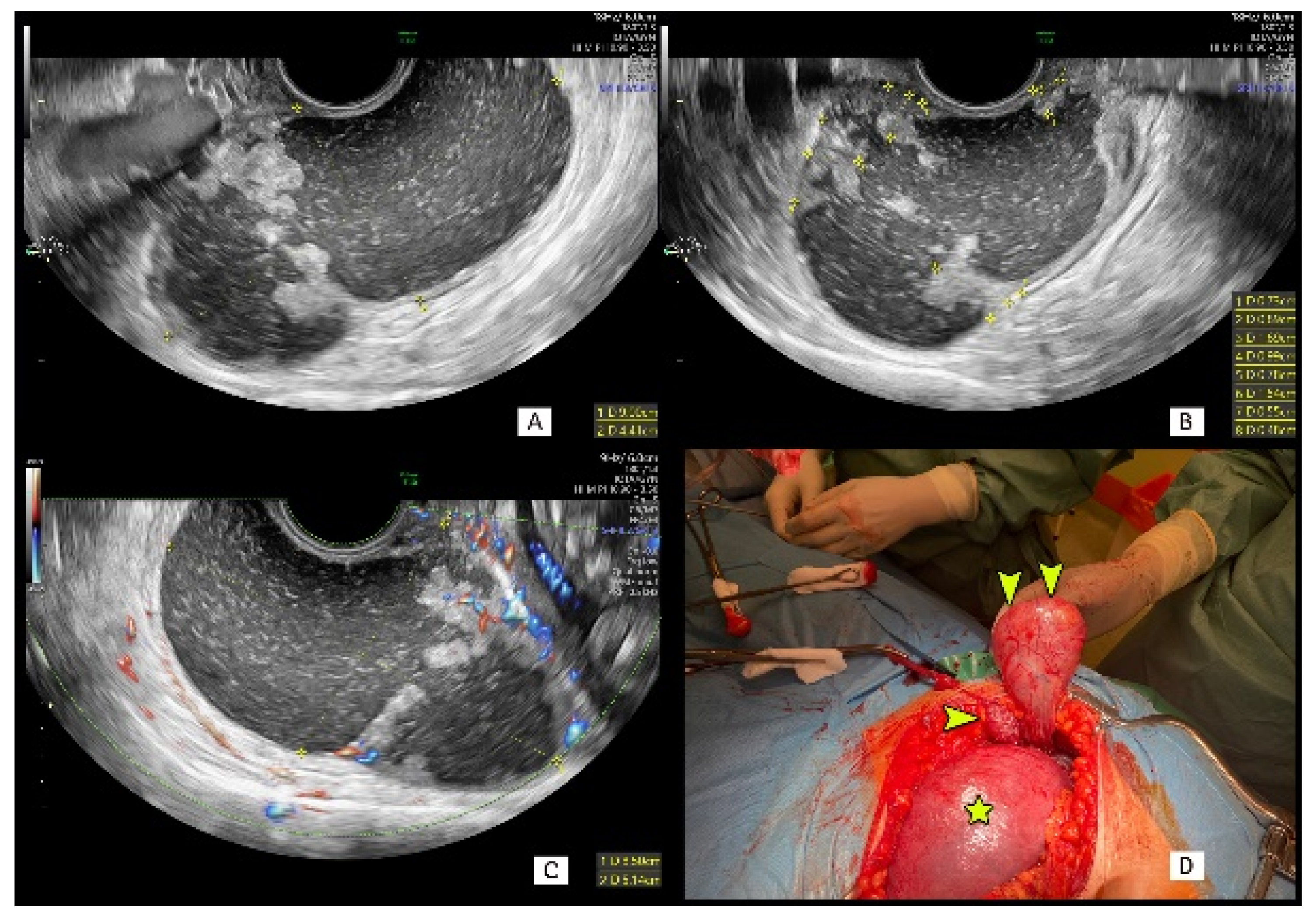 Calcification in ovary ultrasound