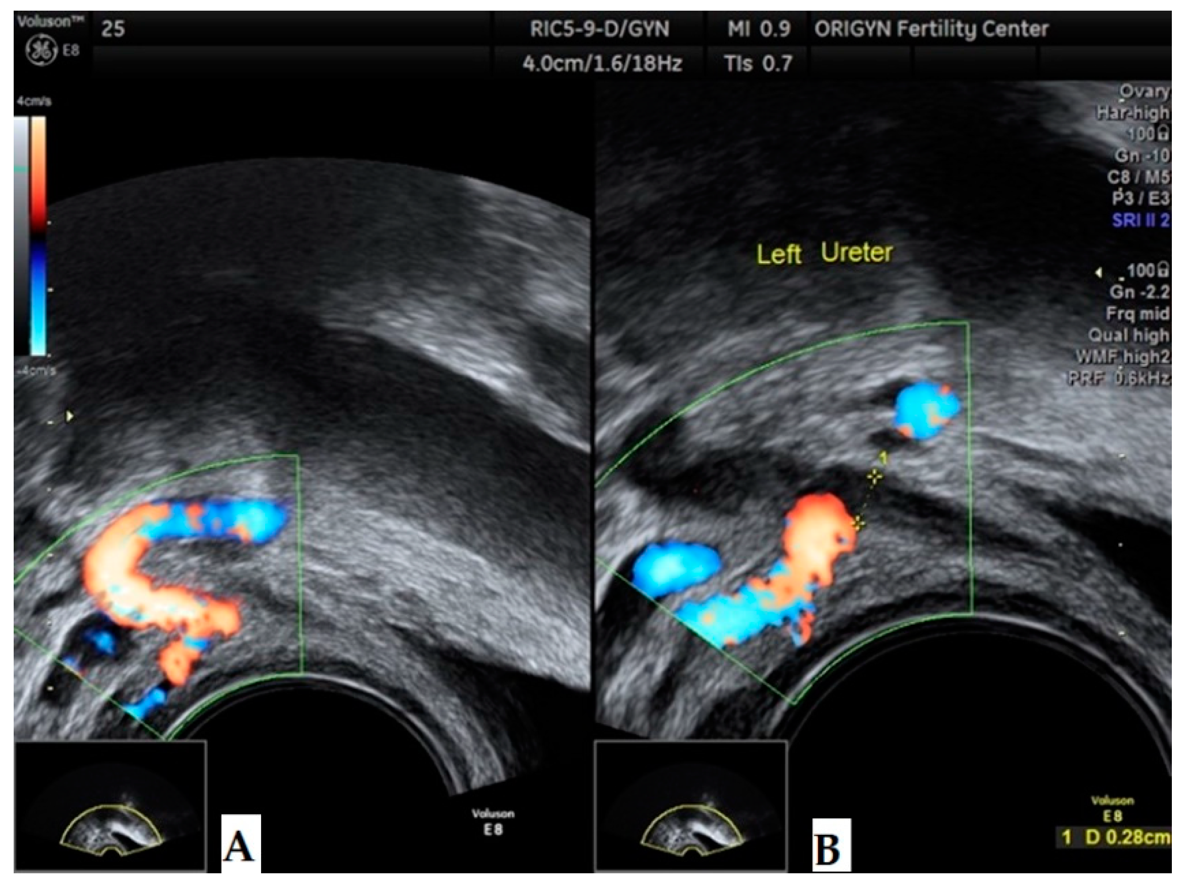 Diagnostics | Free Full-Text | Transvaginal Ultrasound as a First-Line  Approach in Deep Endometriosis: A Pictorial Essay