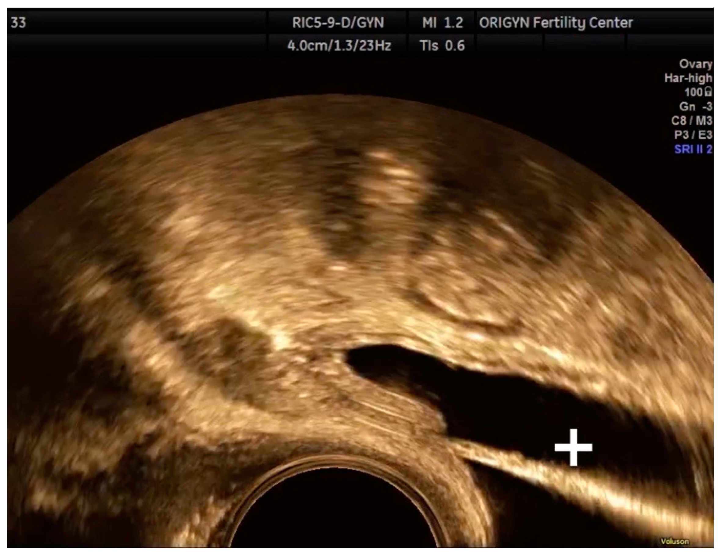 Diagnostics Free Full Text Transvaginal Ultrasound As A First Line Approach In Deep Endometriosis A Pictorial Essay Html