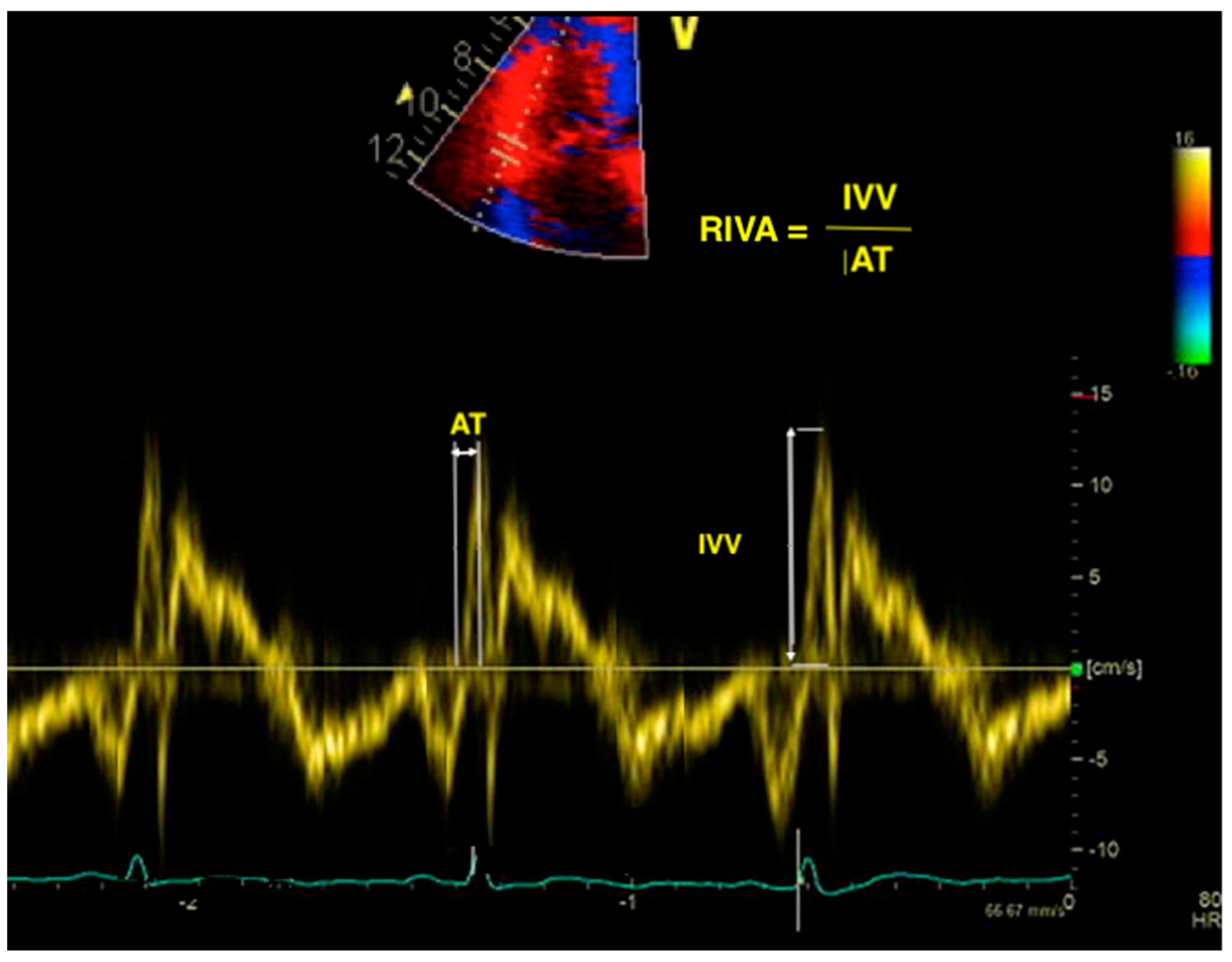 Diagnostics | Free Full-Text | Forgotten No More—The Role of Right  Ventricular Dysfunction in Heart Failure with Reduced Ejection Fraction: An  Echocardiographic Perspective
