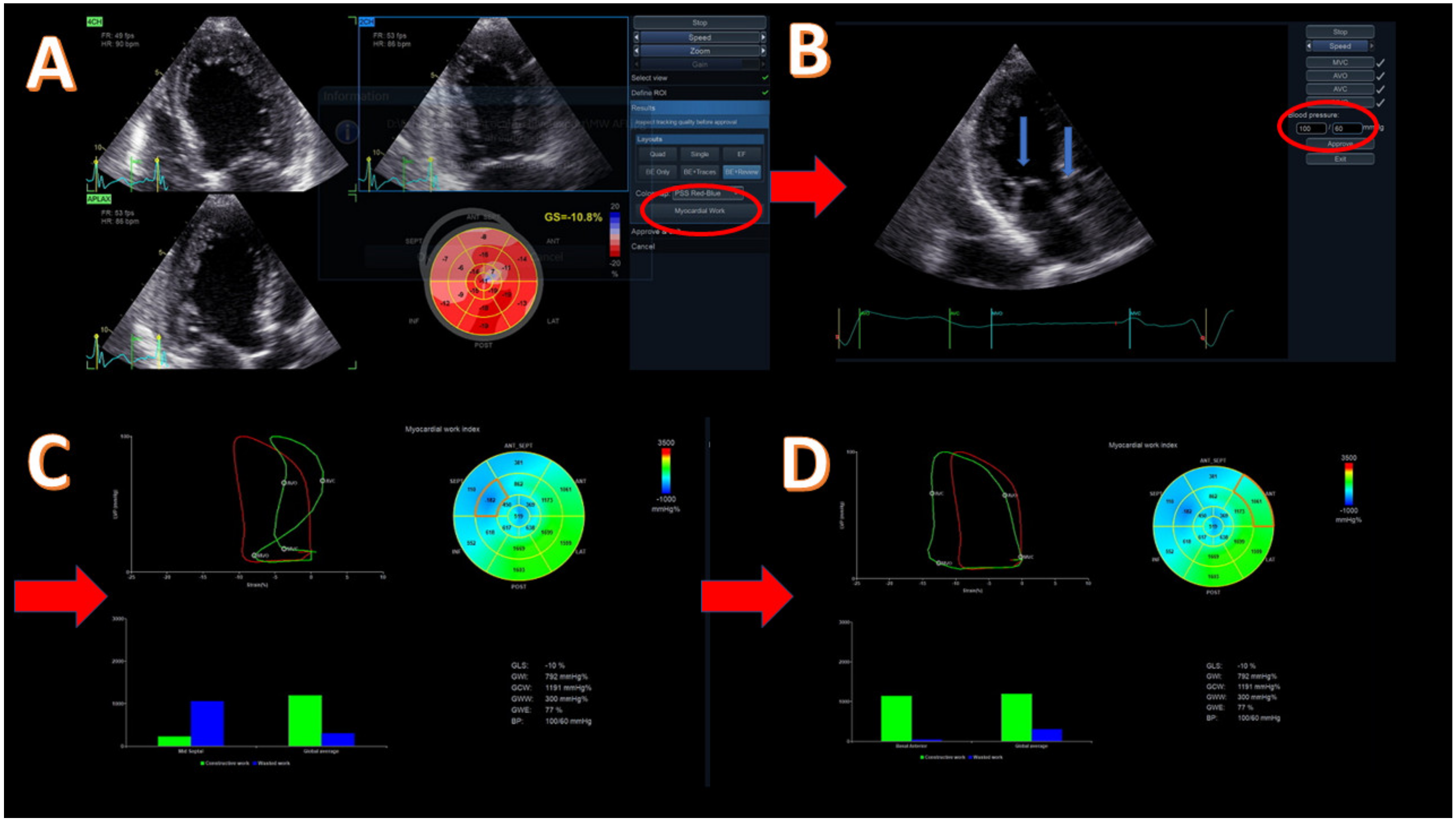 Normal Values for Myocardial Work Indices Derived From Pressure