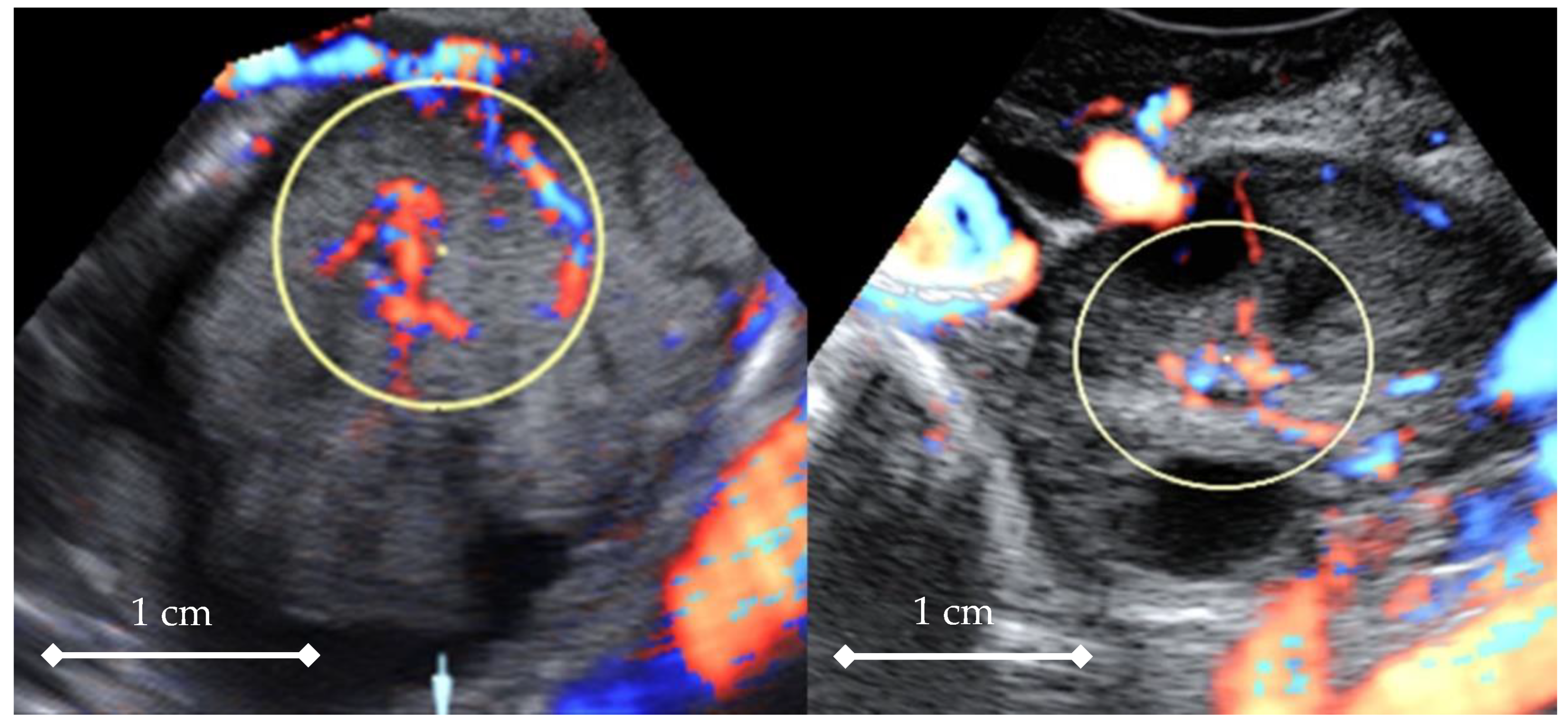 Calcification in ovary ultrasound